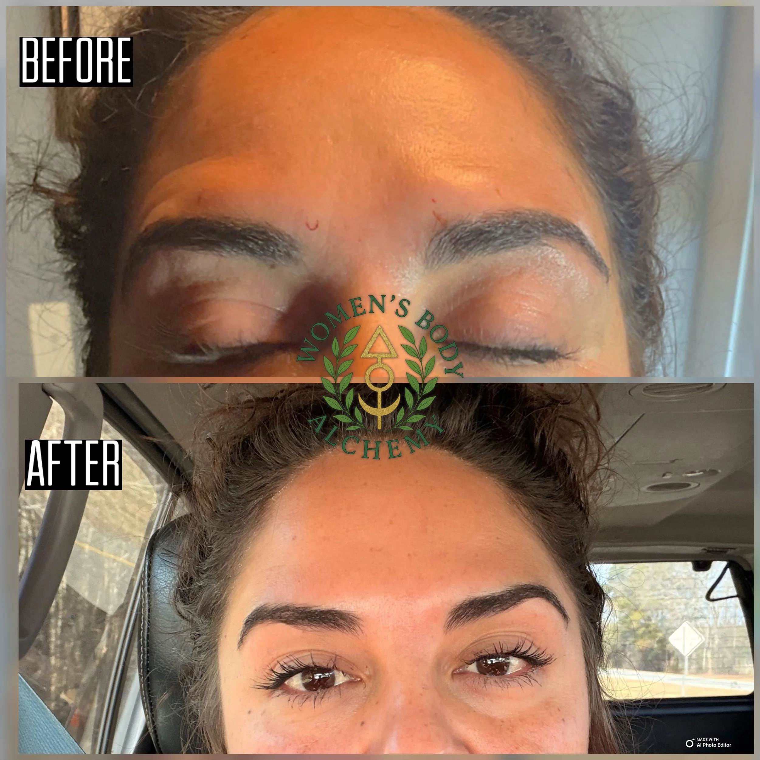 Feminization of the Forehead