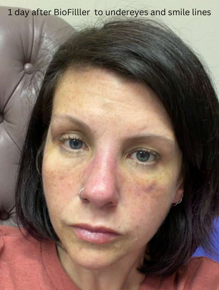 Close-up of a woman's face showing slight swelling and smile lines one day after BioFiller treatment, with visible under-eye area and skin discoloration.