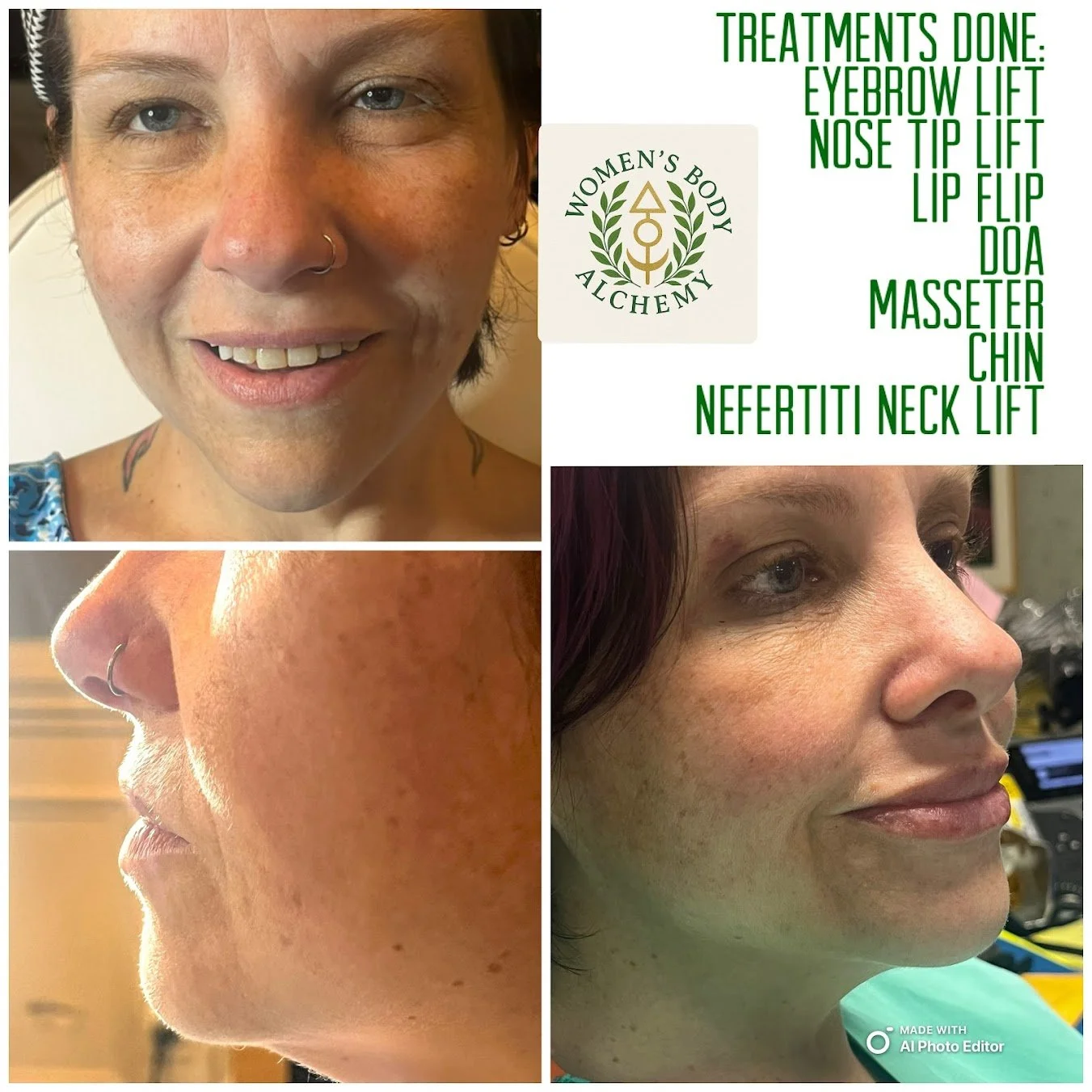 Before and after photos of a woman showing facial improvements following cosmetic treatments. The before images display her with natural wrinkles and skin texture, while the after images show smoother, more lifted skin around the eyebrows, nose tip, lips, chin, and neck. Text highlights treatments done, including eyebrow lift, nose tip lift, lip flip, DOA, masseter reduction, chin enhancement, and neck lift.