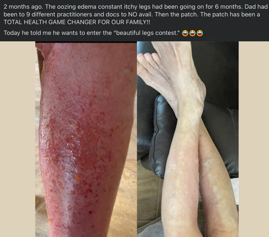 Oozing edema went on for over 6 months.  Then the patch was a game changer.