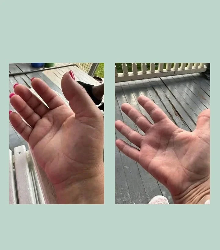 Joint swelling and pain reduced after 2 months