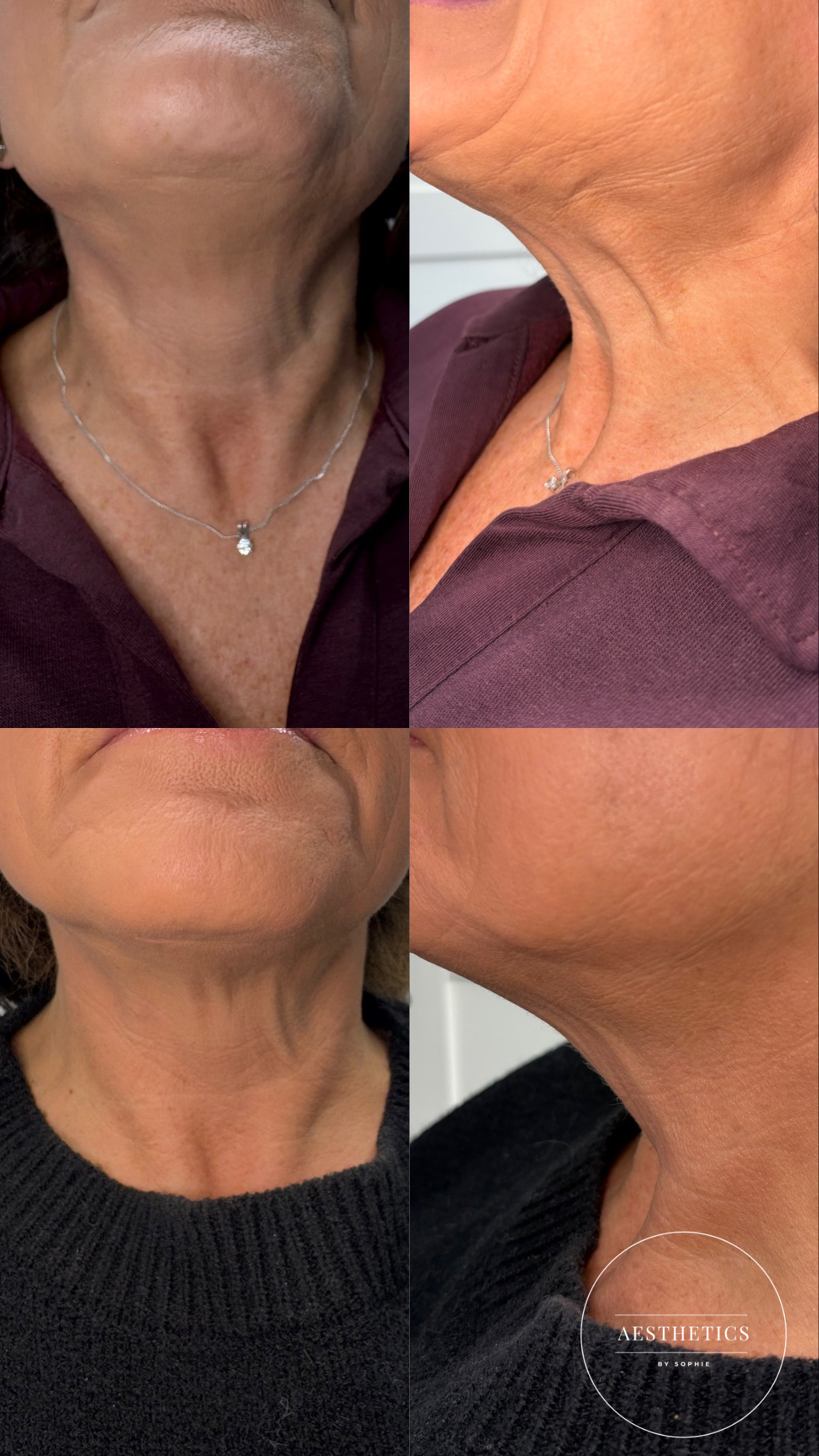 four images showing neck lifting treatment