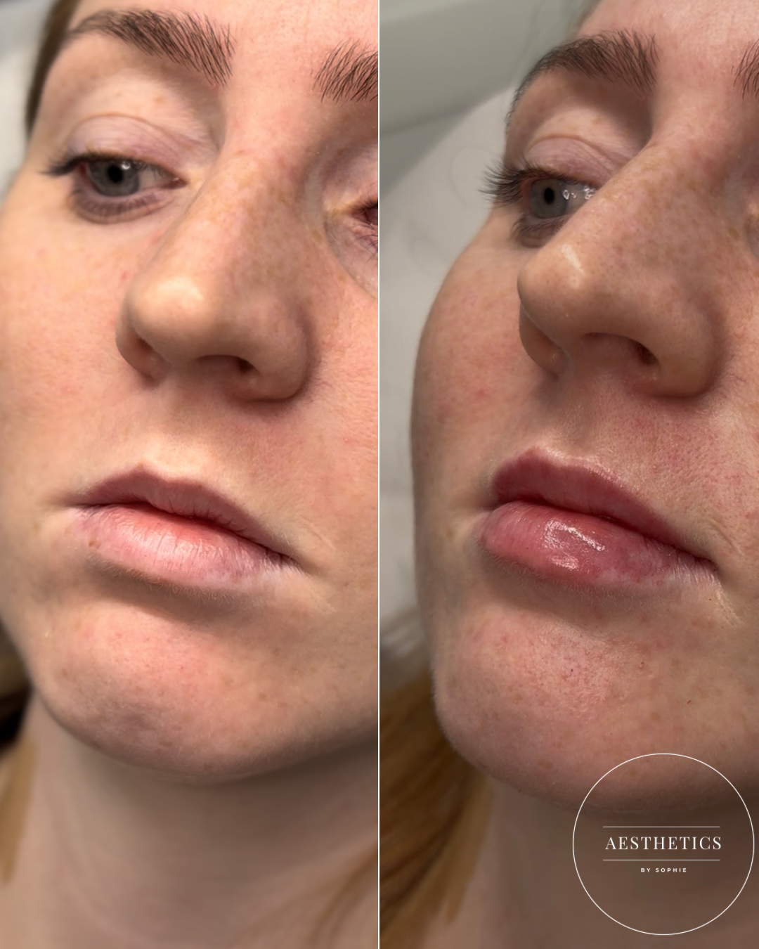 Close-up of a woman's face showing a before and after of lip enhancement, with the left image showing natural lips and the right image showing fuller, glossy lips. 