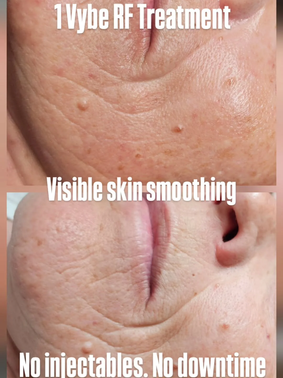 Your skincare didn&rsquo;t fail you.
It just can&rsquo;t do this.

This is the result after ONE Vybe RF treatment 👆
Softer fine lines, smoother skin, and improved texture &mdash; without injectables or downtime.

Vybe RF helps: &bull; soften fine li
