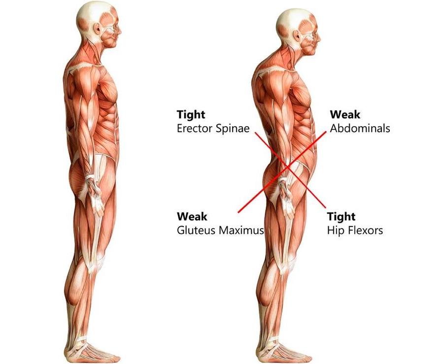 Low back pain from poor posture