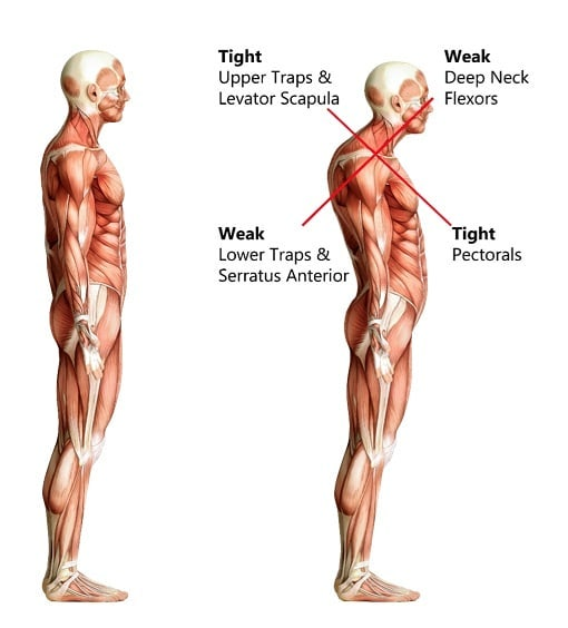 Posture pain from sitting or rounded shoulders