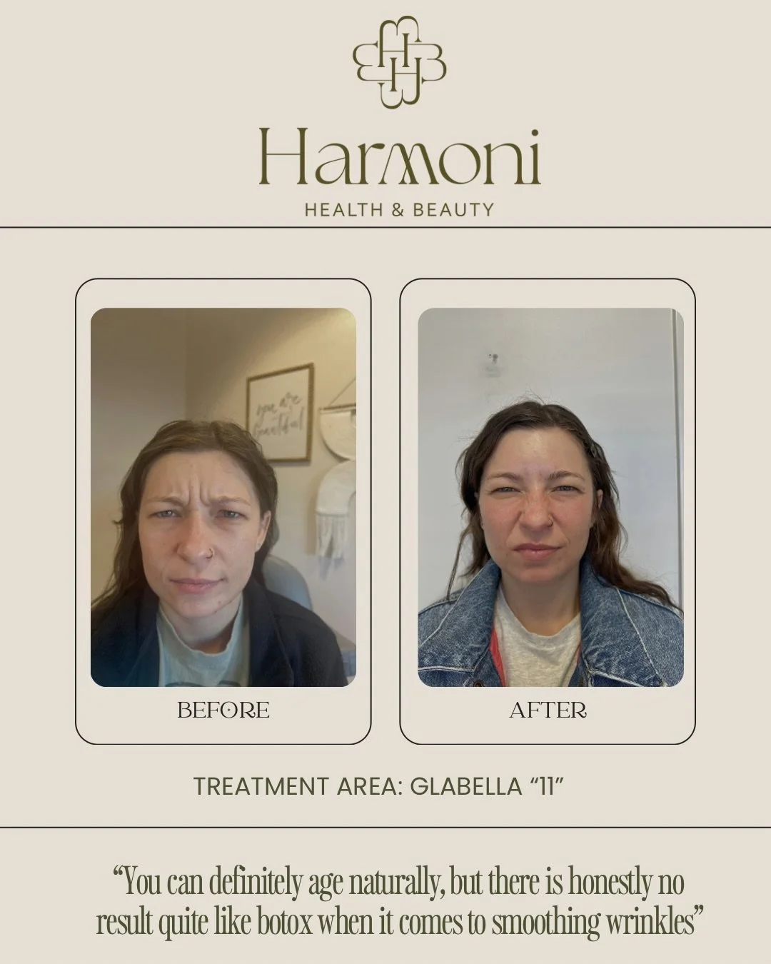 There is a reason neurotoxin is one of the most loved aesthetic treatments ✨

By relaxing the muscles that create wrinkles, treatments for the forehead and glabella can leave skin looking smoother, softer, and more refreshed.

Natural results are alw