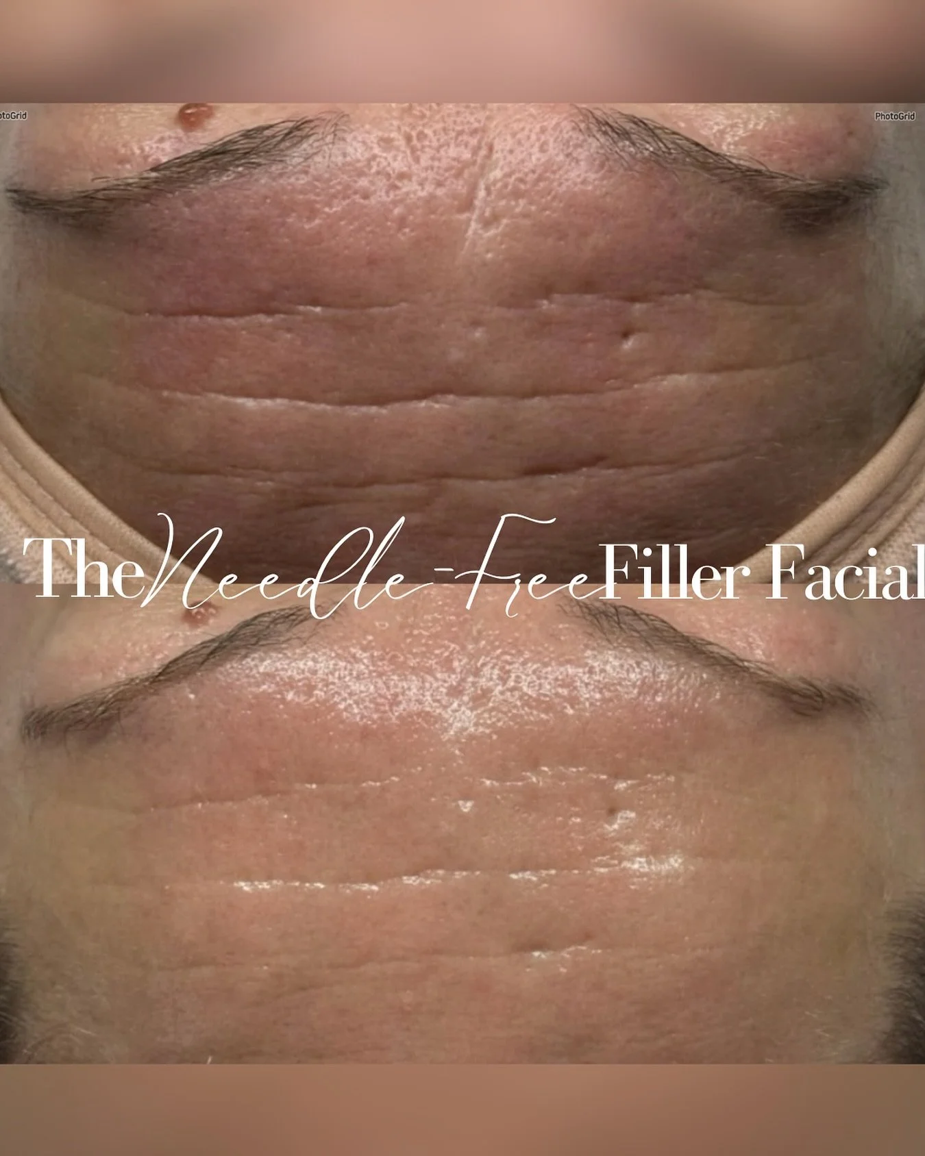 The collagen-boosting facial everyone&rsquo;s talking about &mdash; minus the needles.

Our Needle-Free Filler Facial, AKA the House of PLLA&reg; HOP+ Pilleo Mask Treatment, is a cutting-edge, non-invasive anti-aging protocol that is taps into the po