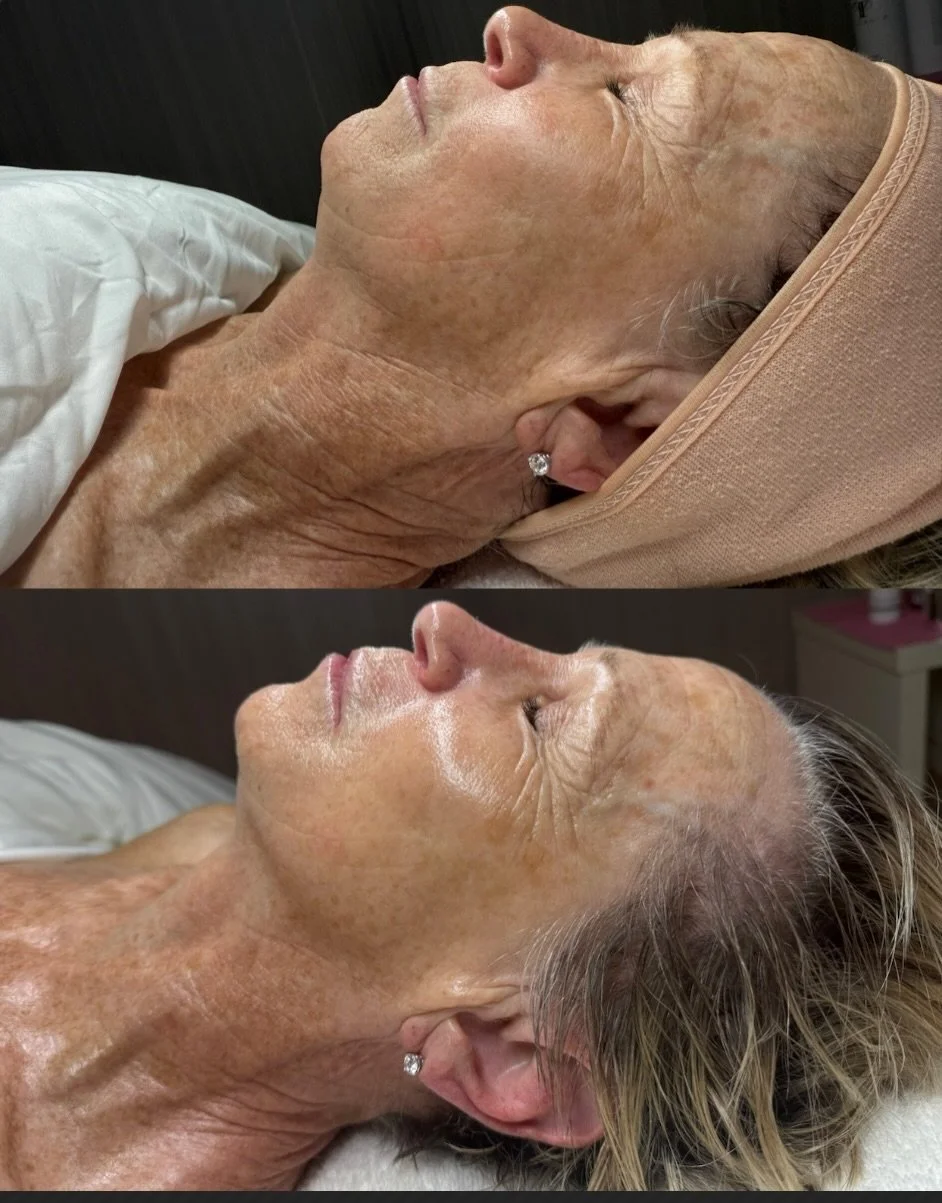NO needles. NO filler. NO filters.
Just this level of skin transformation ✨
The Needle-Free Filler Facial never disappoints 👏🏻 

✨ What&rsquo;s the show-stopping ingredient? 
PLLA (poly-L-lactic acid)

✨What it does:
PLLA is collagen-stimulating in