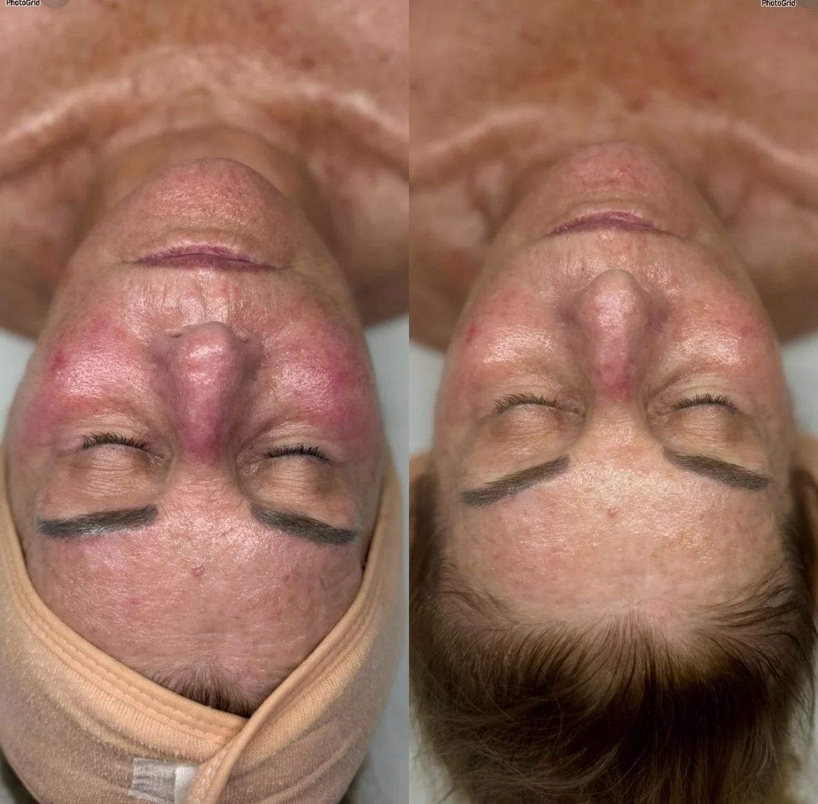 Why live with skin irritations if you don&rsquo;t have to? 

Our treatment protocols deliver real and long lasting results: redness visibly reduced, skin plumped and hydrated, and collagen levels supported for smoother, healthier-looking skin 💧 

Re