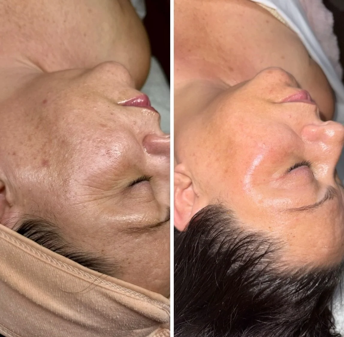 🔔 6 MONTH PROGRESS 🔔

These before &amp; afters are after a series of:
&bull; 3 Liquid Microneedling treatments
&bull; 3 Circadia Mandi-Clear Peel

✨The details: 
Liquid Microneedling is a no-needle spicule treatment that creates microchannels in t