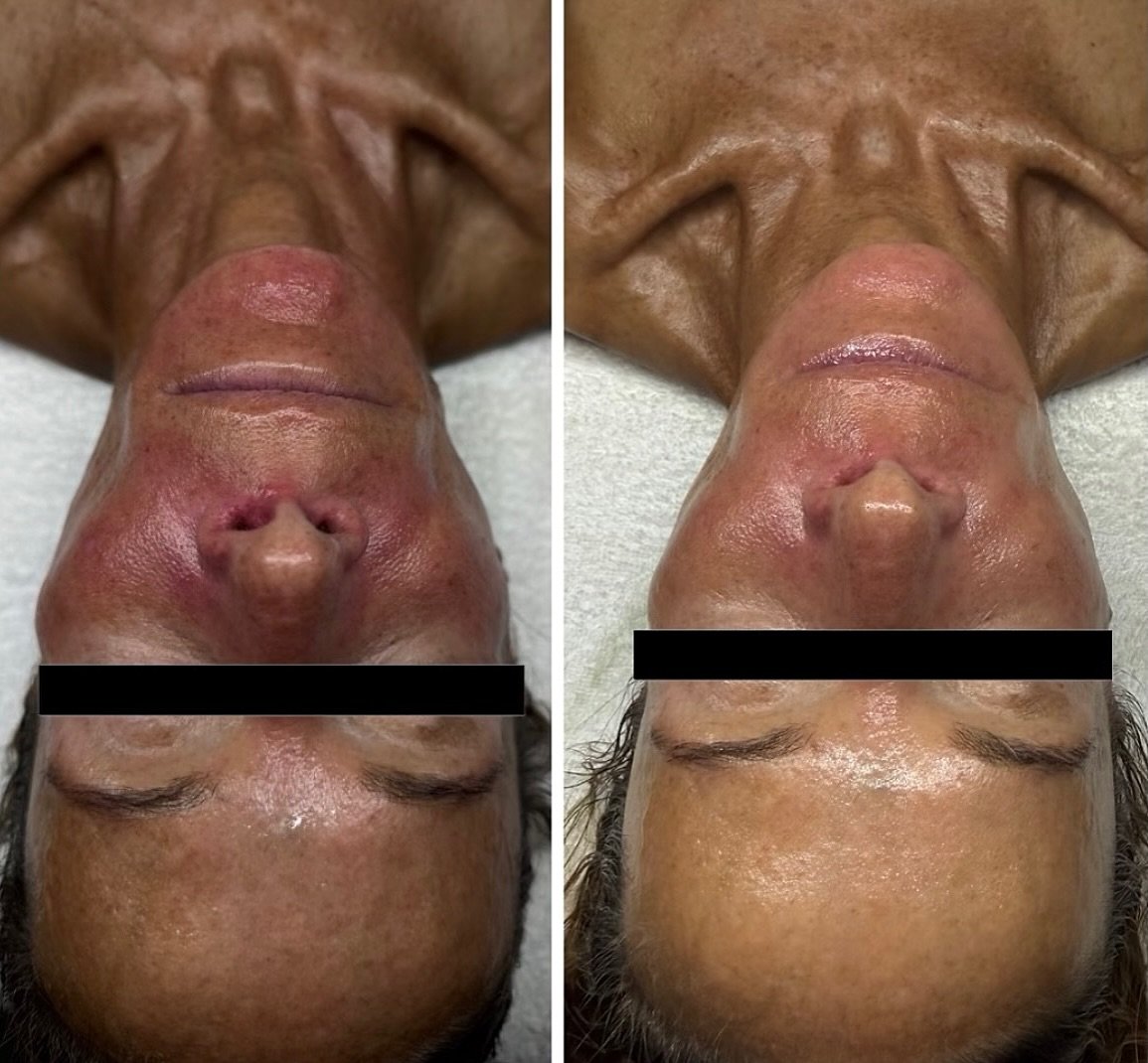 90 minutes later&hellip; 💭

Custom Protocol created:
💧Double cleanse with @circadia Vitamin Veil and @dr.esthe_official Moisture Gel Cleanser
💧Dermaplane 
💧One pass hydrodermabrasion with ruffle tip and hyaluronic acid @zemits.official 
💧Omega G