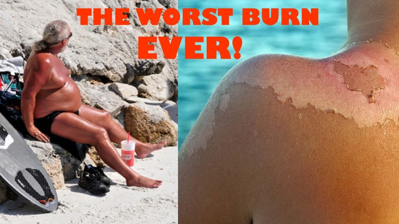 The Worst Burn EVER!