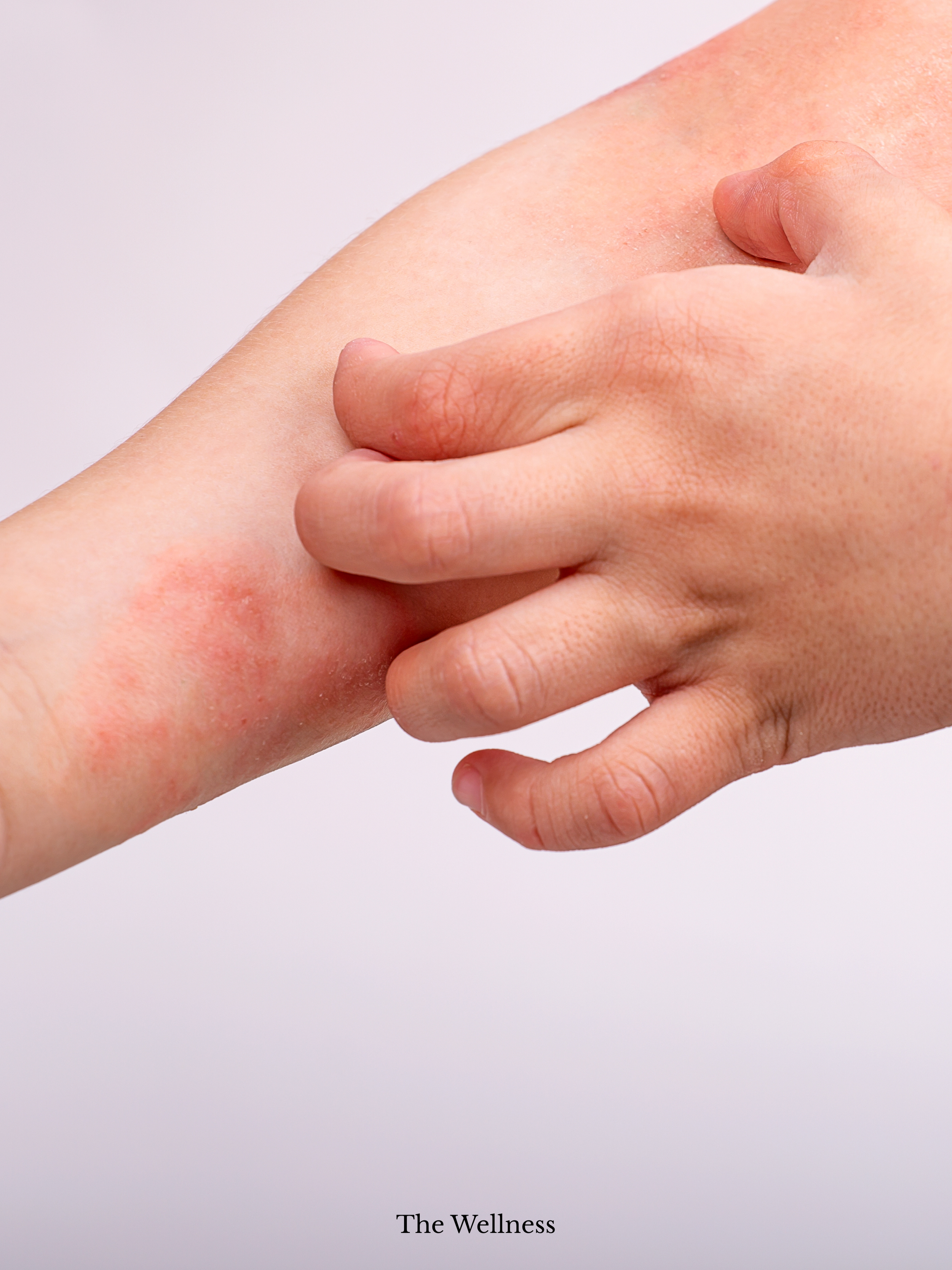 The Eczema Flare-Up That No Pharmacy Cream Could Fix (Until an Online GP Prescribed What Actually Works)