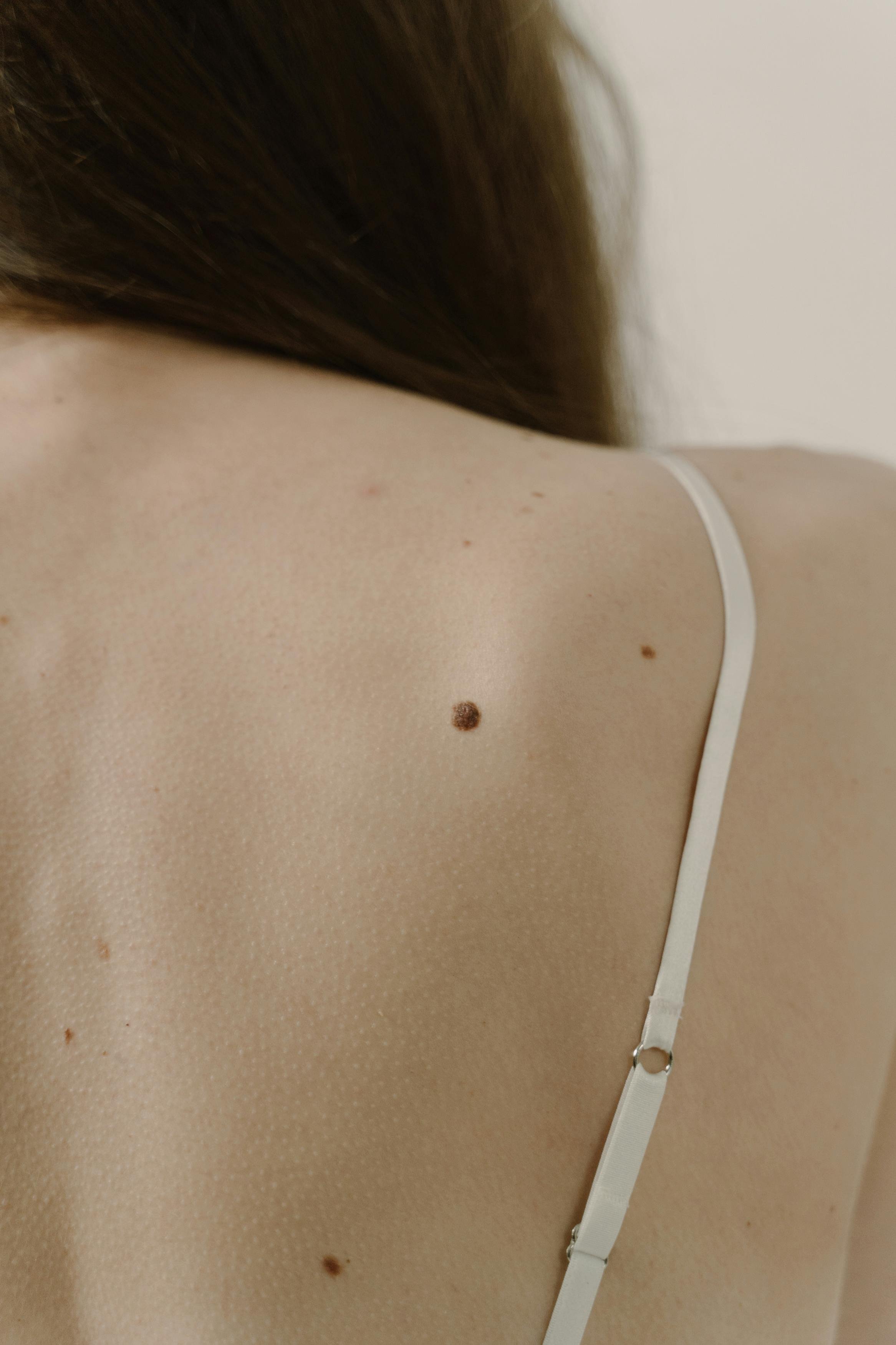 Mole Check in London. Skin Cancer Screening That Catches It Early