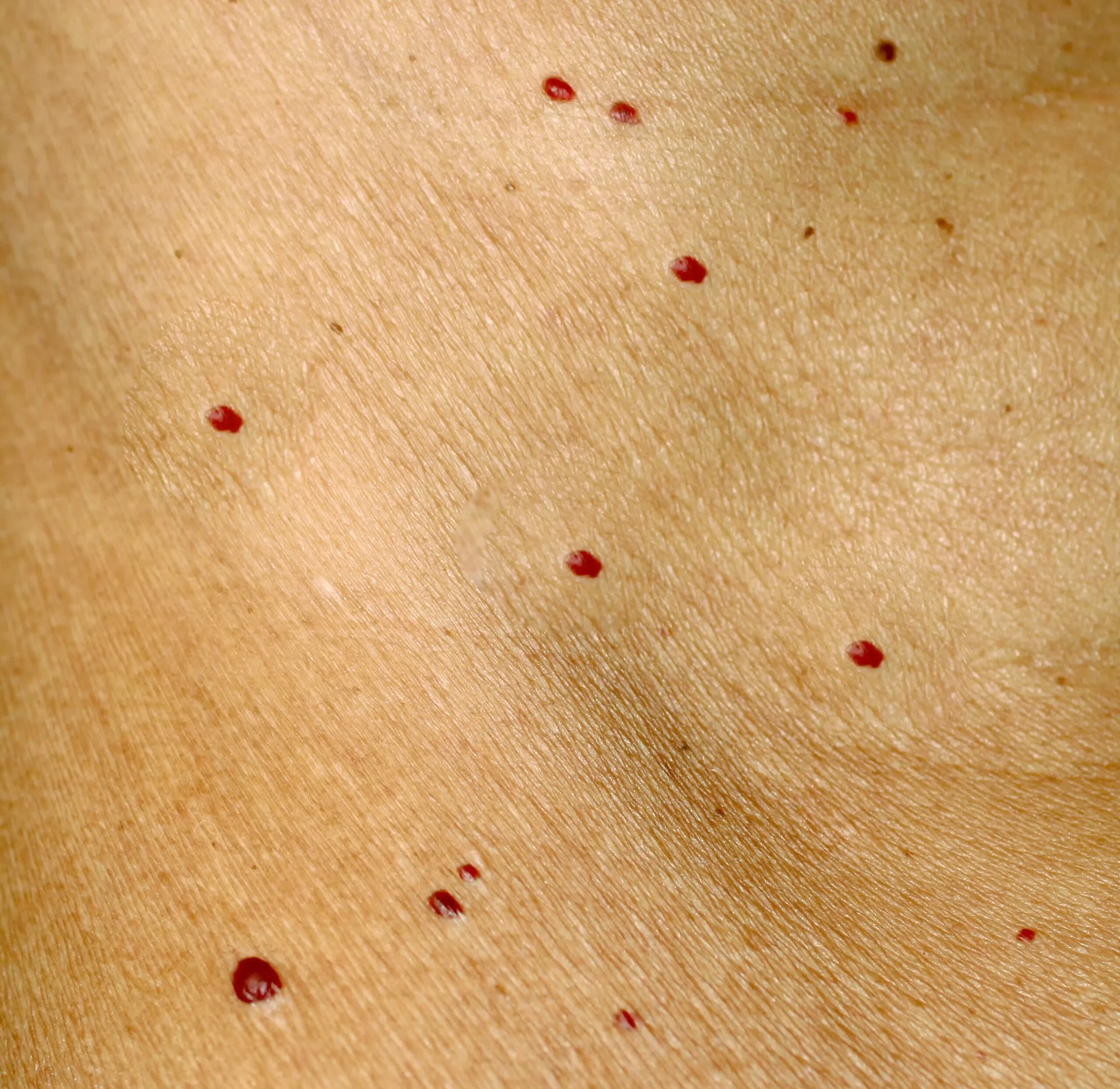 Cherry Angioma Removal London 2026. Same-Day Doctor-Led Electrocautery at The Online GP by The Wellness