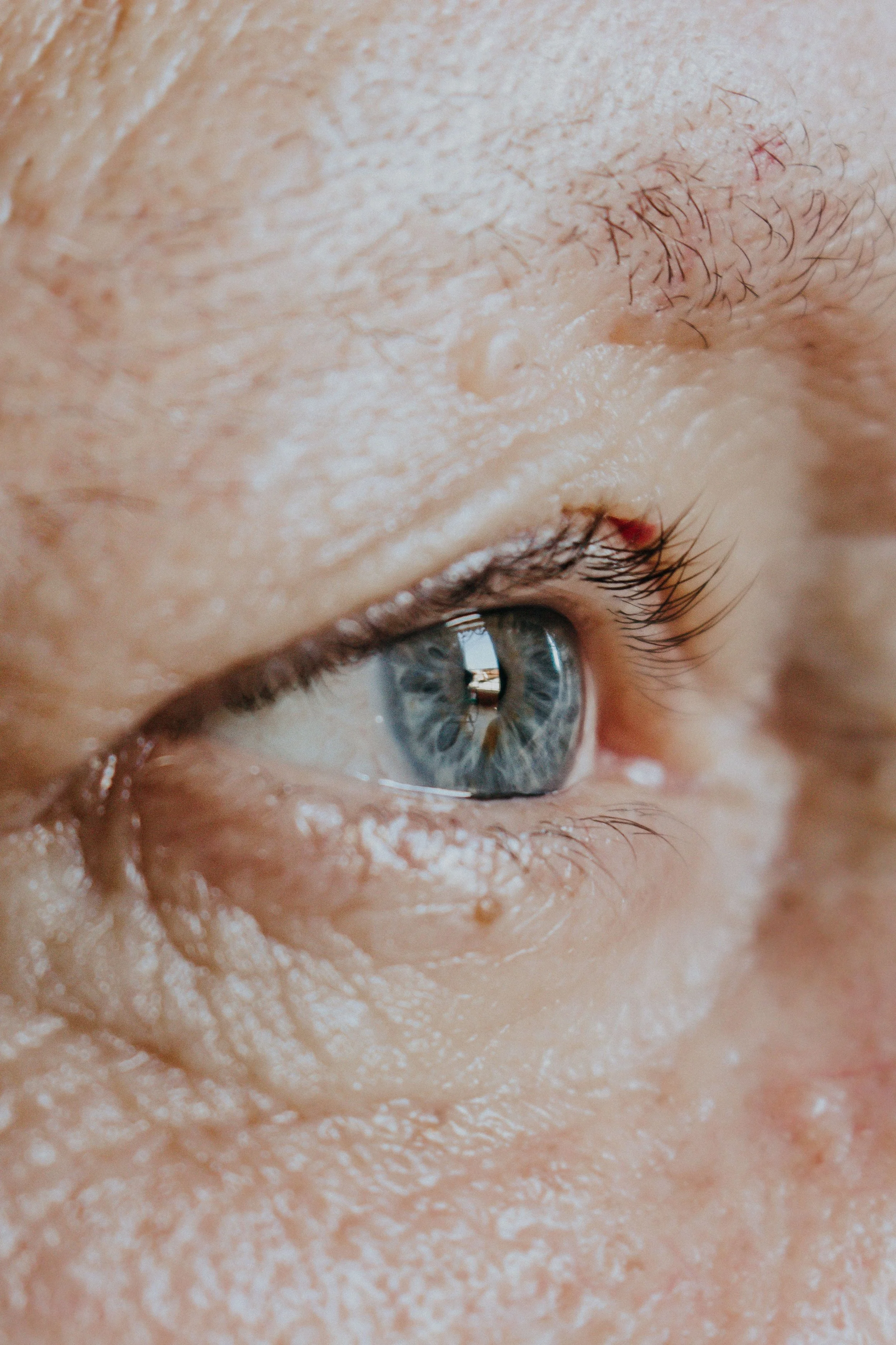 Xanthelasma Removal London 2026. Doctor-Led Removal With Cholesterol Assessment at The Online GP by The Wellness