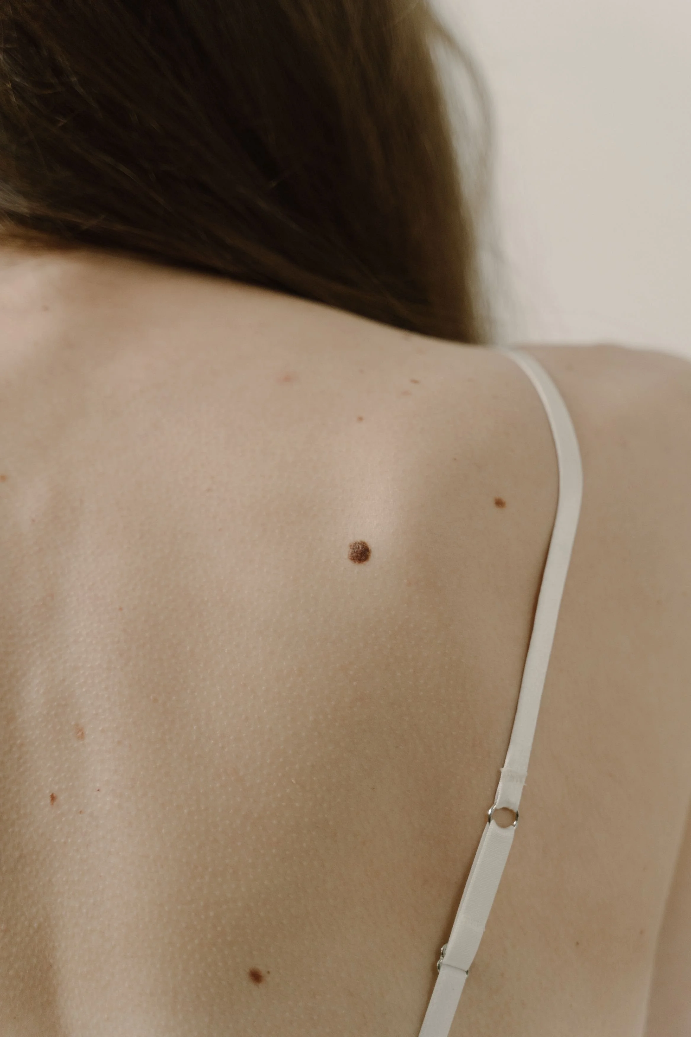 Mole Removal London 2026. Doctor-Led Removal With Dermoscopy and Histology at The Online GP by The Wellness