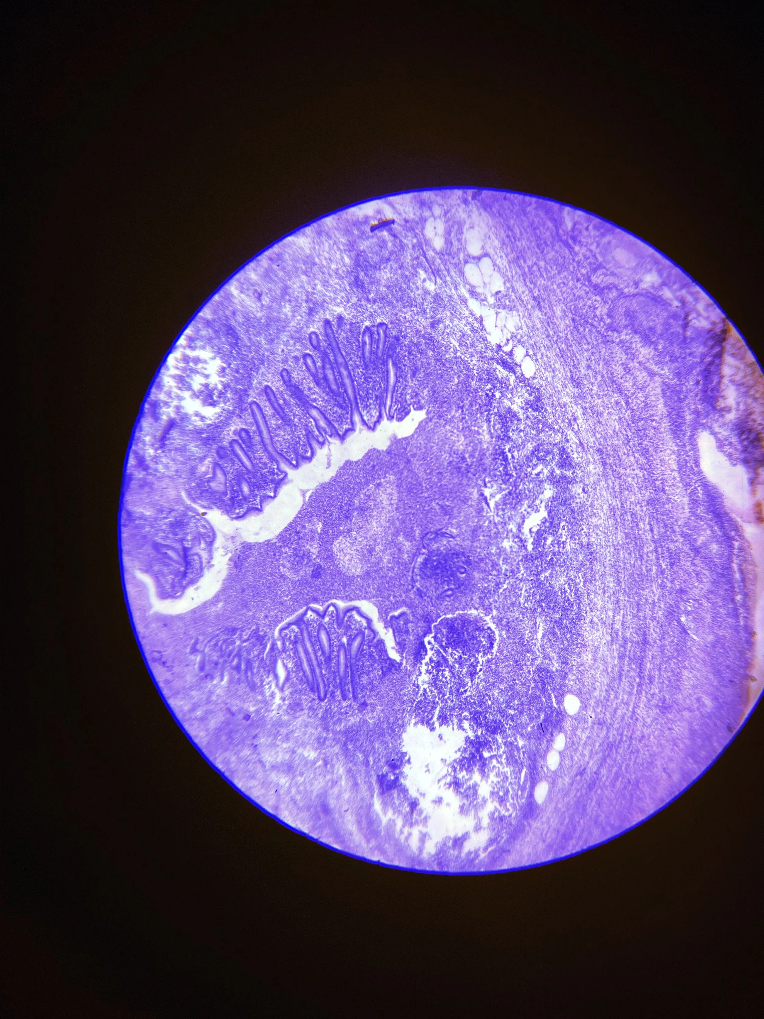 Sebaceous Cyst Removal London 2026. Same-Day Doctor-Led Excision at The Online GP by The Wellness