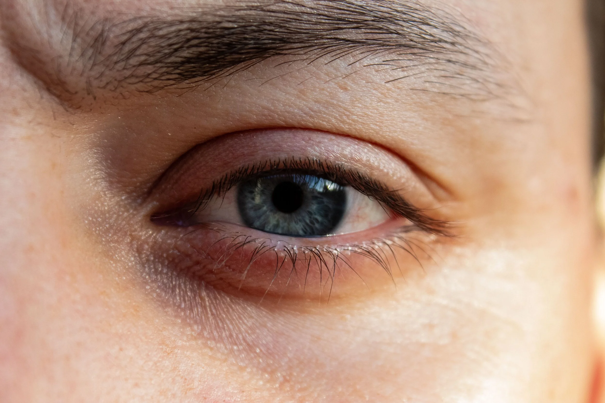 Chalazion and Eyelid Cyst Treatment London 2026. Why Warm Compresses Stop Working, What Removal Costs, and the Lump That Needs Checking