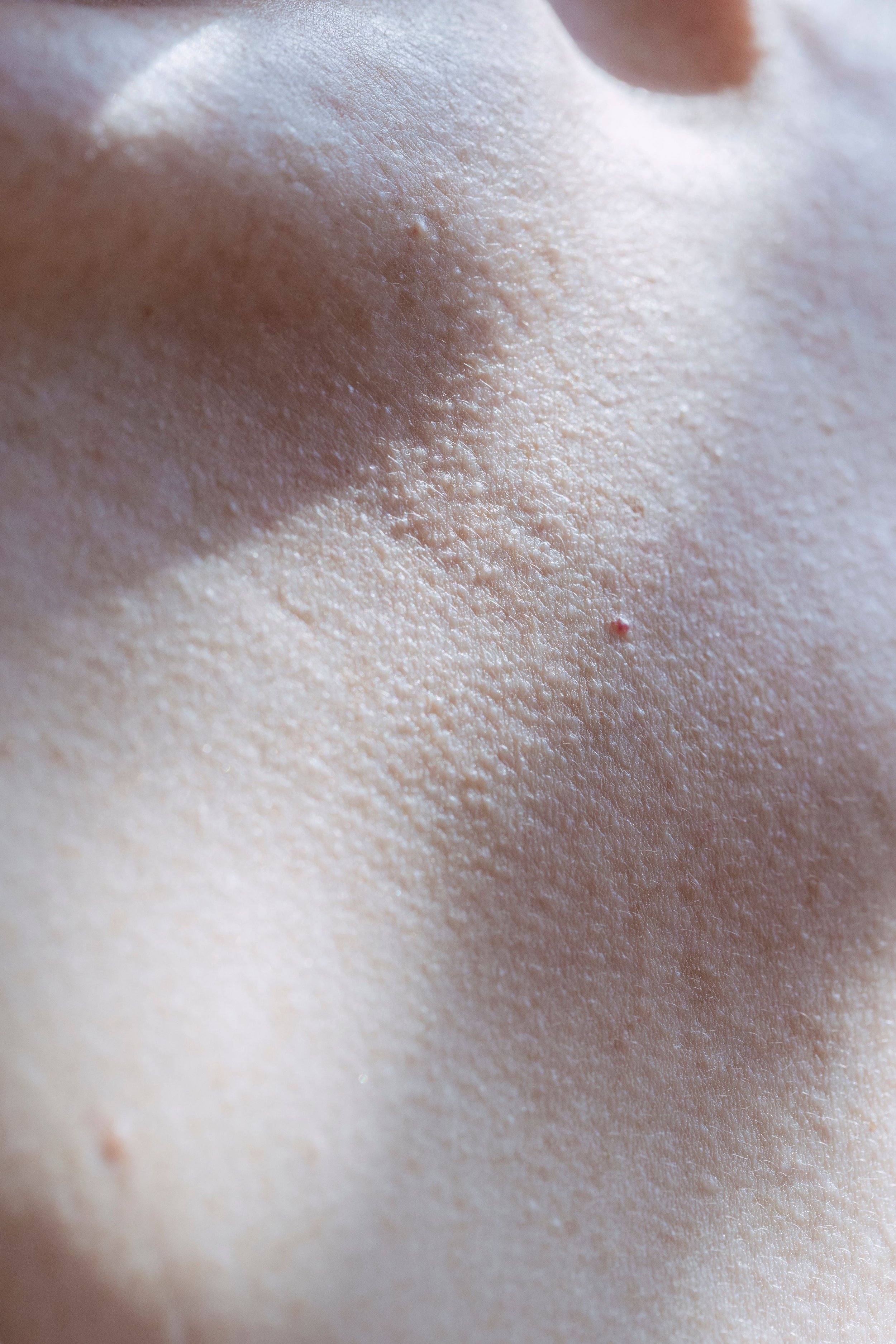 Seborrhoeic Keratosis Removal in London 2026. Age Spots, Stuck-On Lesions and Doctor-Led Removal in One Visit