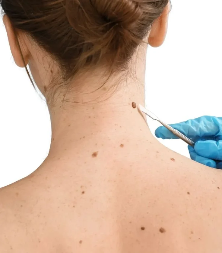 Skin Cancer and Mole Checks in London 2026. What to Look For, What a Proper Check Involves and When to Worry