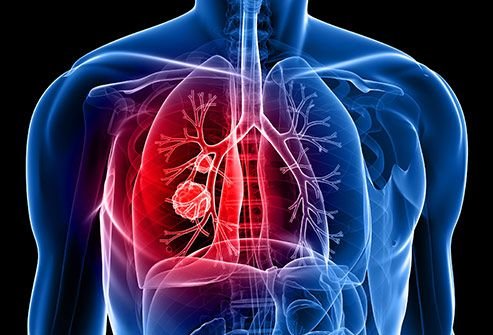 Lung Cancer Screening in London 2026. Who Should Have a Low-Dose CT, What the NHS Programme Covers and Why a Chest X-Ray Is Not Screening