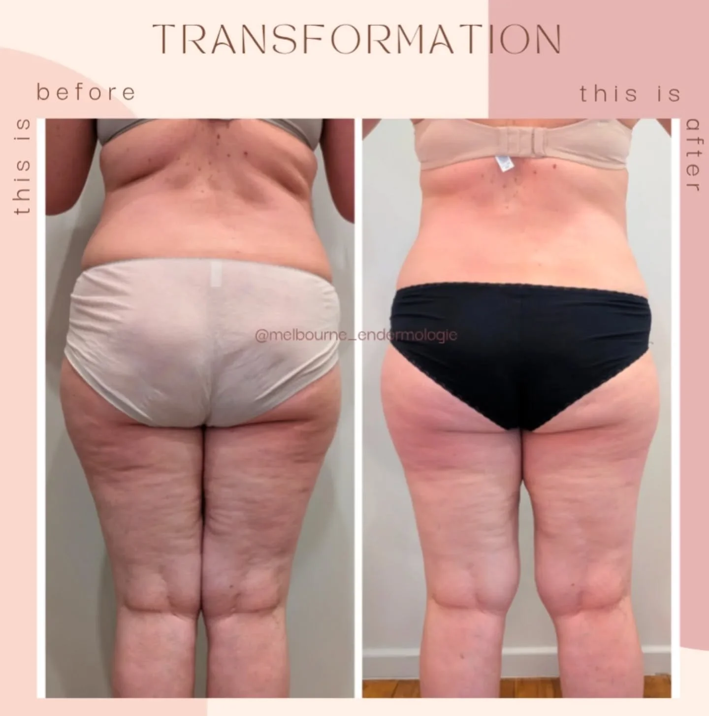 ✨
#endermologie #cellulite #cellulitetreatment #cellulitesolution #bodycontouring #skintightening #lpgendermologie #lymphaticdrainage #lymphaticmassage #lpgendermologie