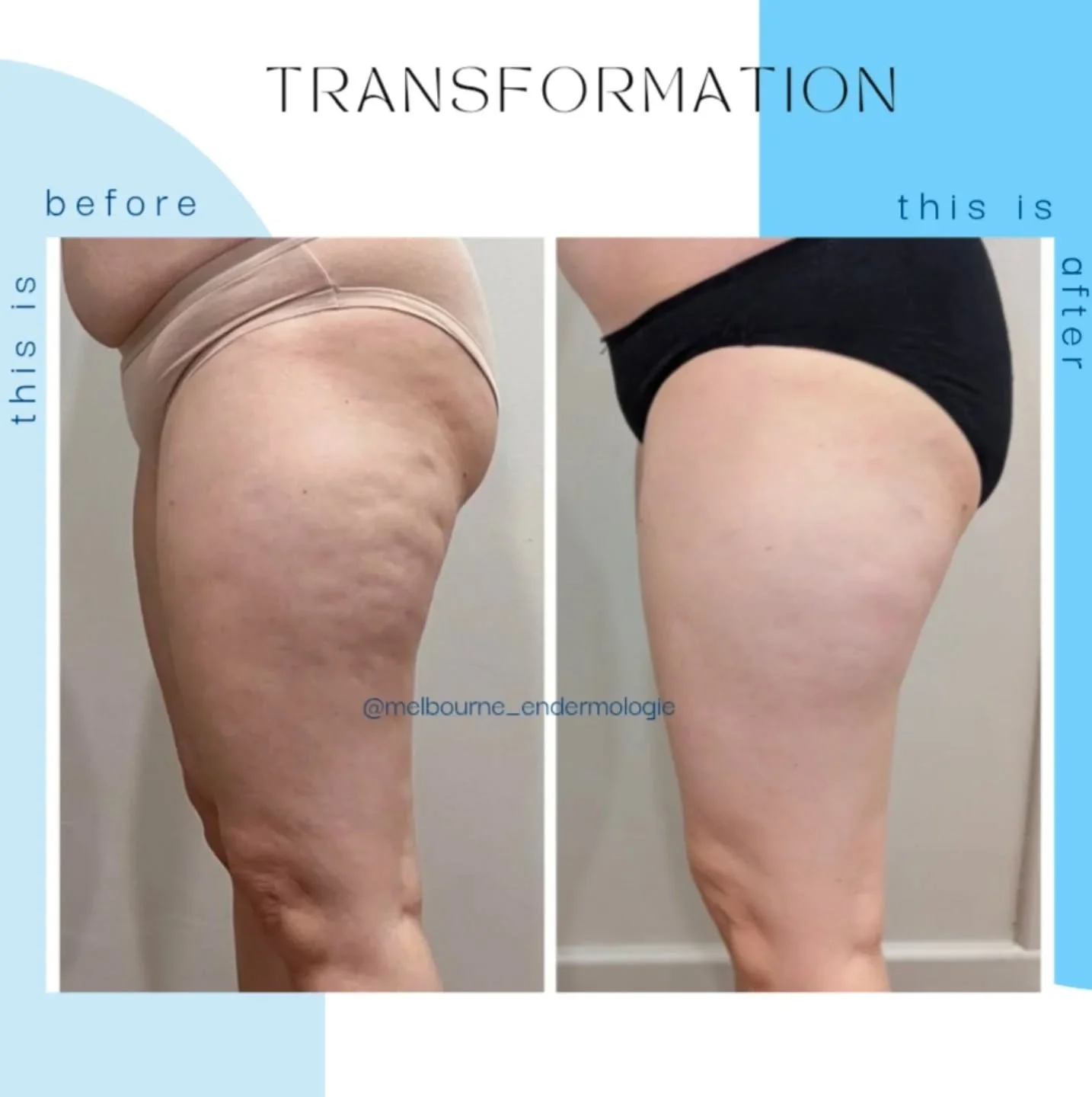 ✨ Look at her now 😍
#endermologie #cellulite #cellulitetreatment #cellulitesolution #bodycontouring #skintightening #lpgendermologie #lymphaticdrainage #lymphaticmassage #lpgendermologie