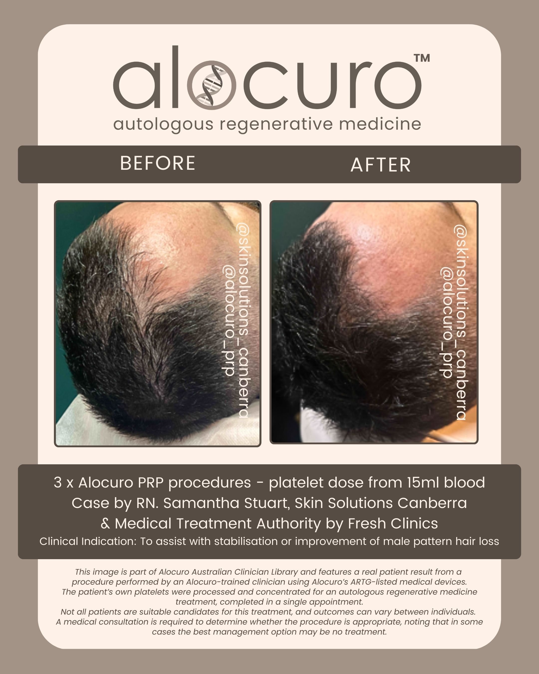 Alocuro Hair Case PRP - Before & After - 01.jpg