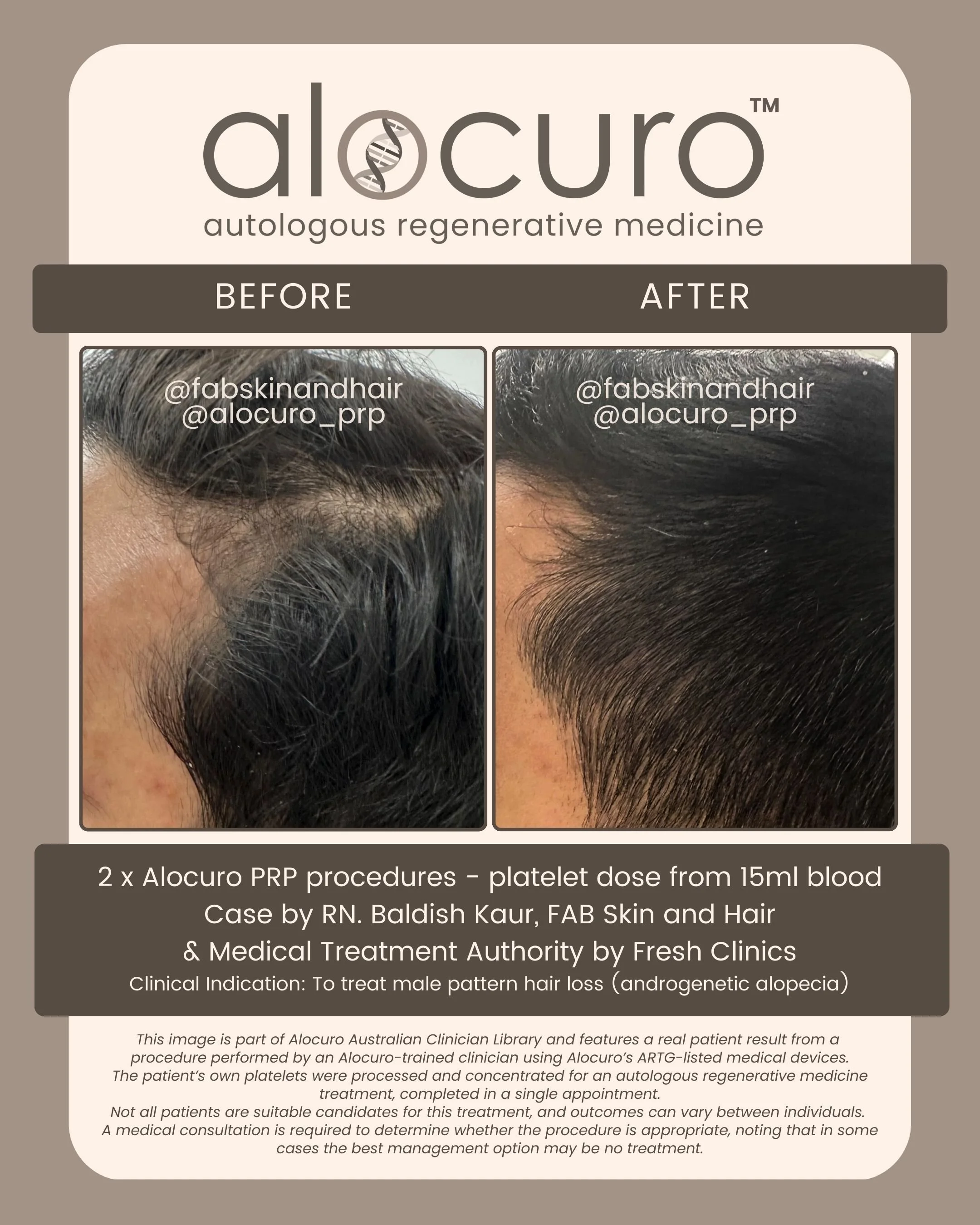 Alocuro Hair Case PRP - Before & After - 08.jpg