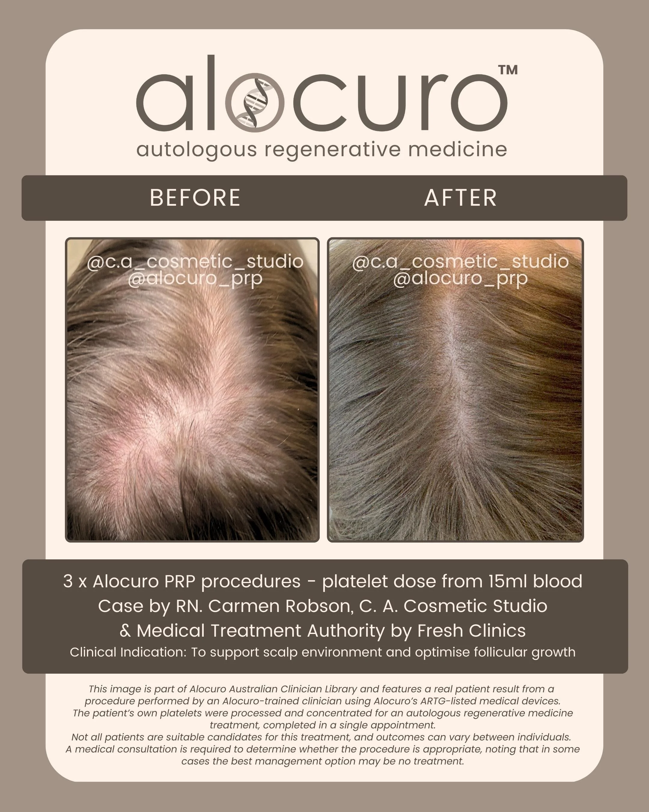 Alocuro Hair Case PRP - Before & After - 09.jpg