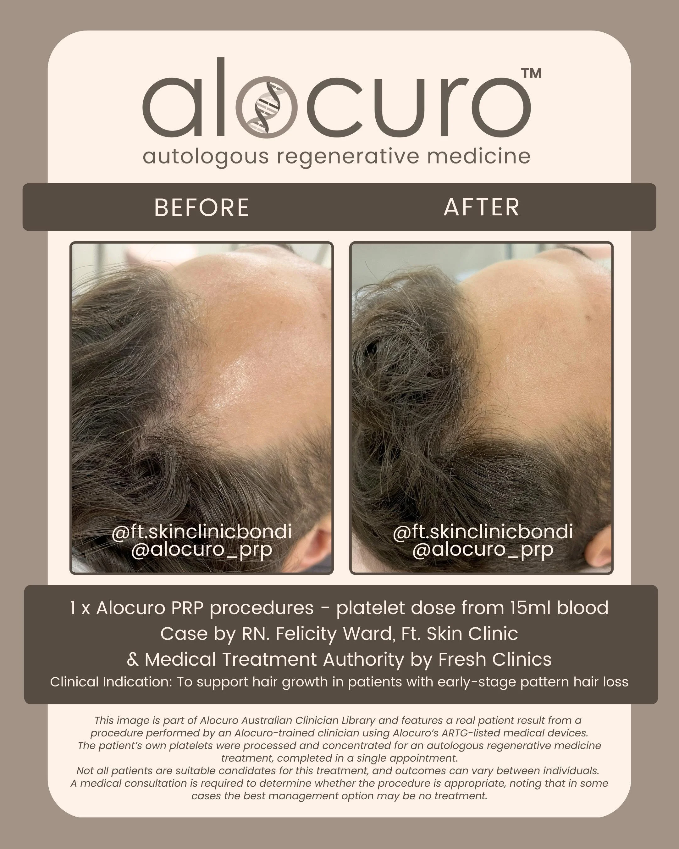 Alocuro Hair Case PRP - Before & After - 10.jpg
