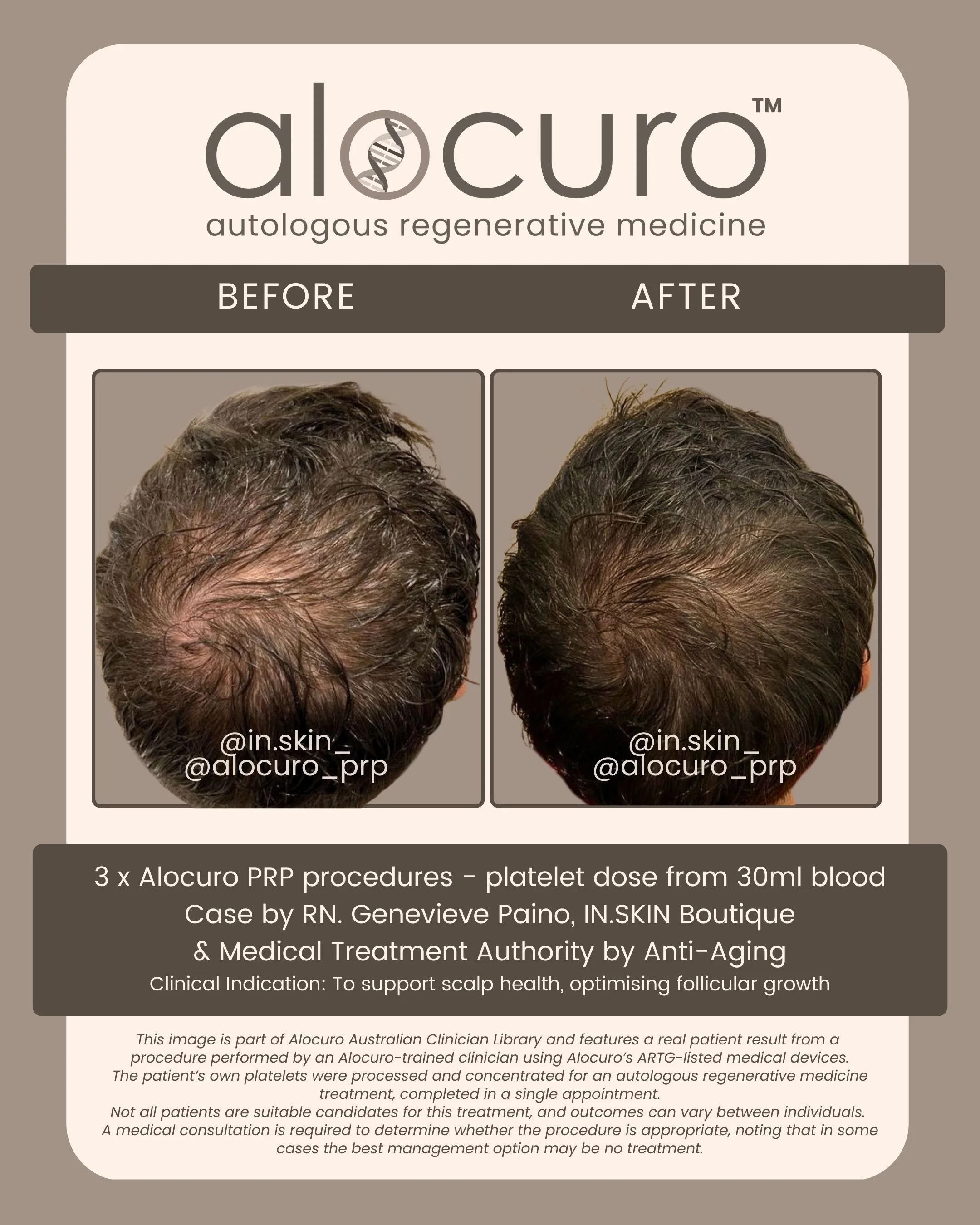 Alocuro Hair Case PRP - Before & After - 11.jpg