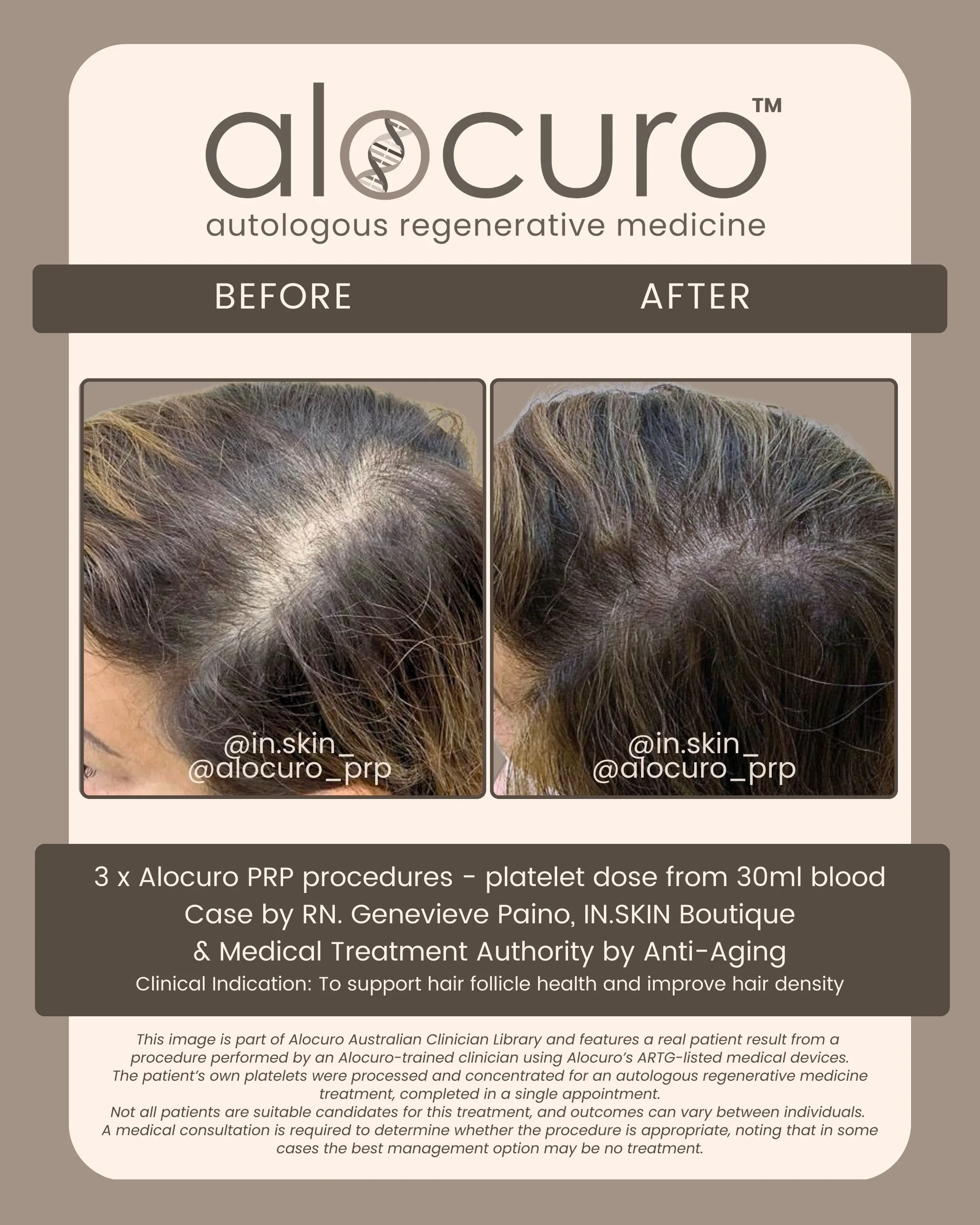 Alocuro Hair Case PRP - Before & After - 12.jpg