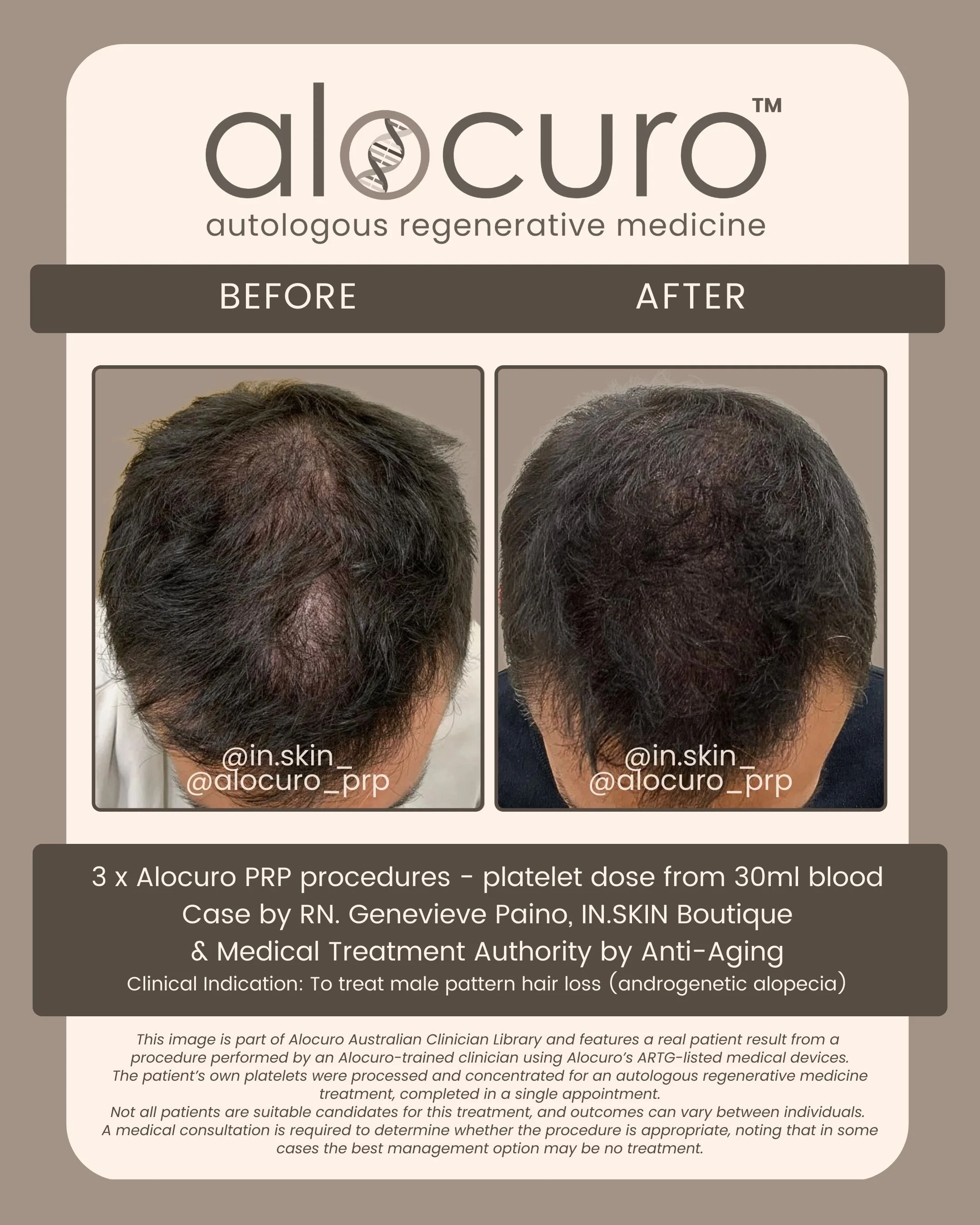 Alocuro Hair Case PRP - Before & After - 13.jpg