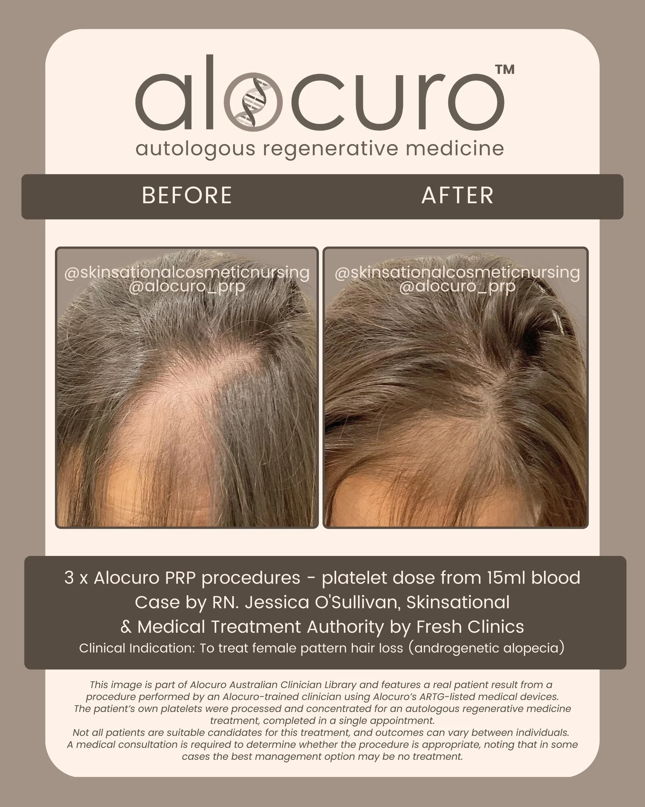 Alocuro Hair Case PRP - Before & After - 15.jpg