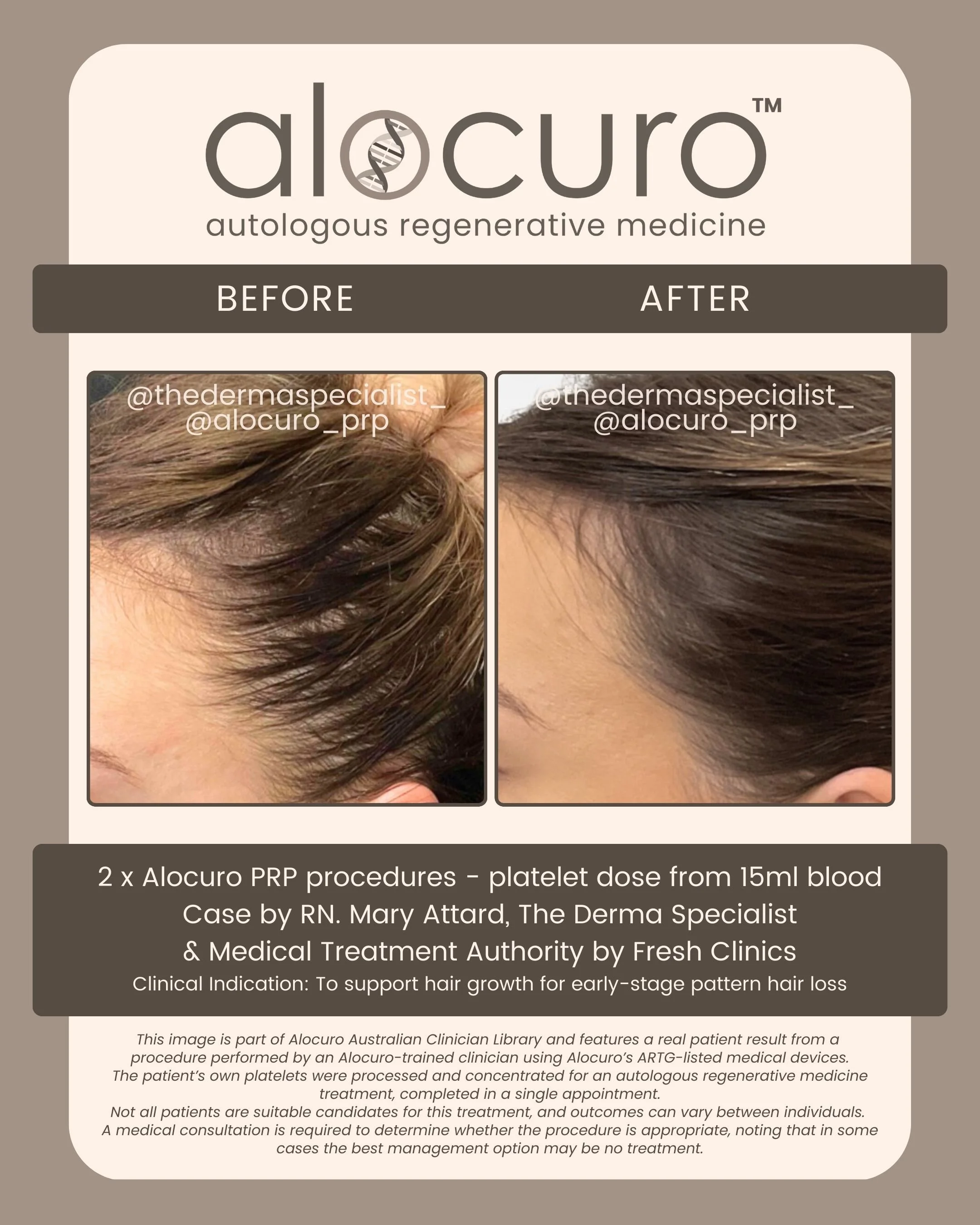 Alocuro Hair Case PRP - Before & After - 19.jpg