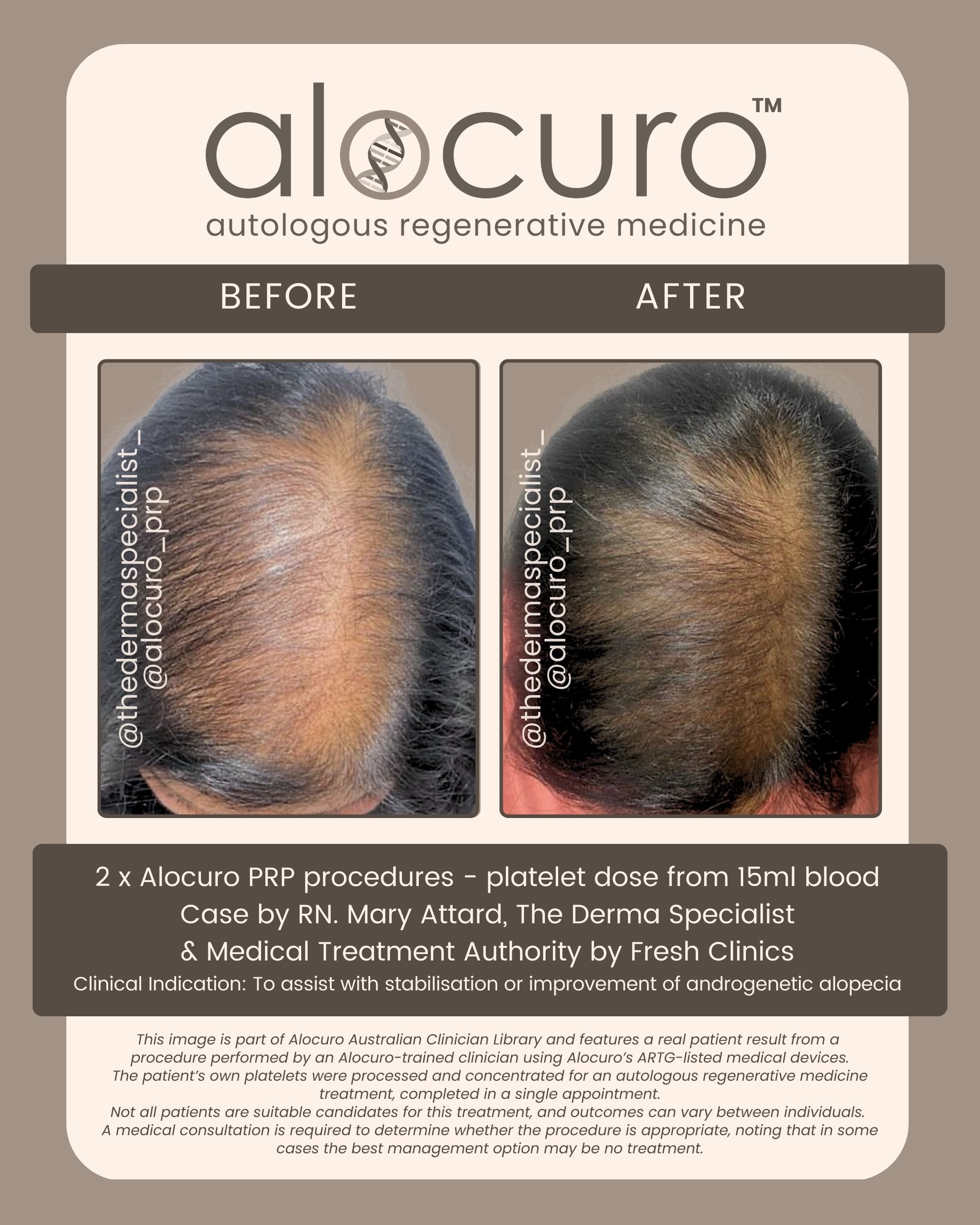 Alocuro Hair Case PRP - Before & After - 20.jpg