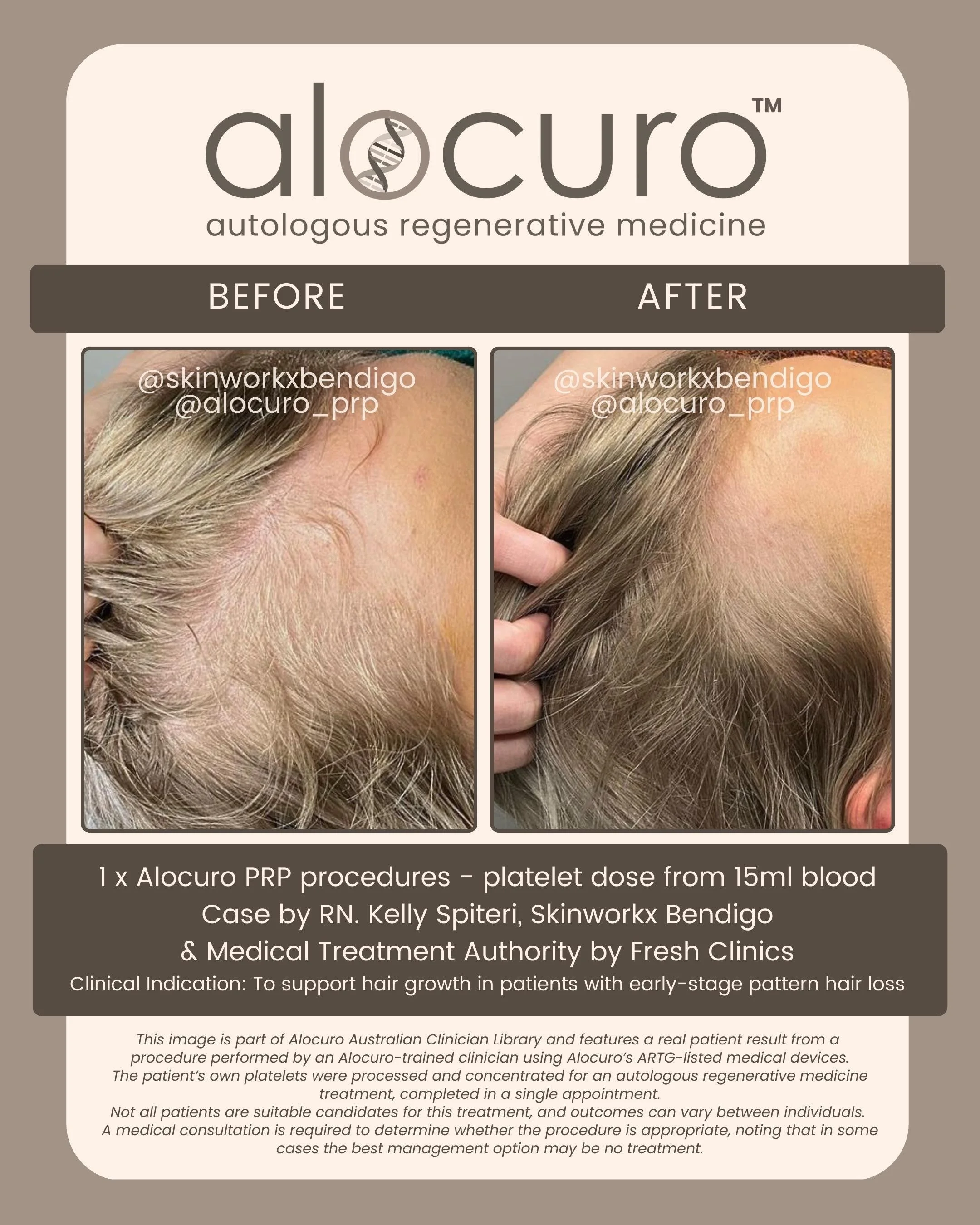 Alocuro Hair Case PRP - Before & After - 16.jpg