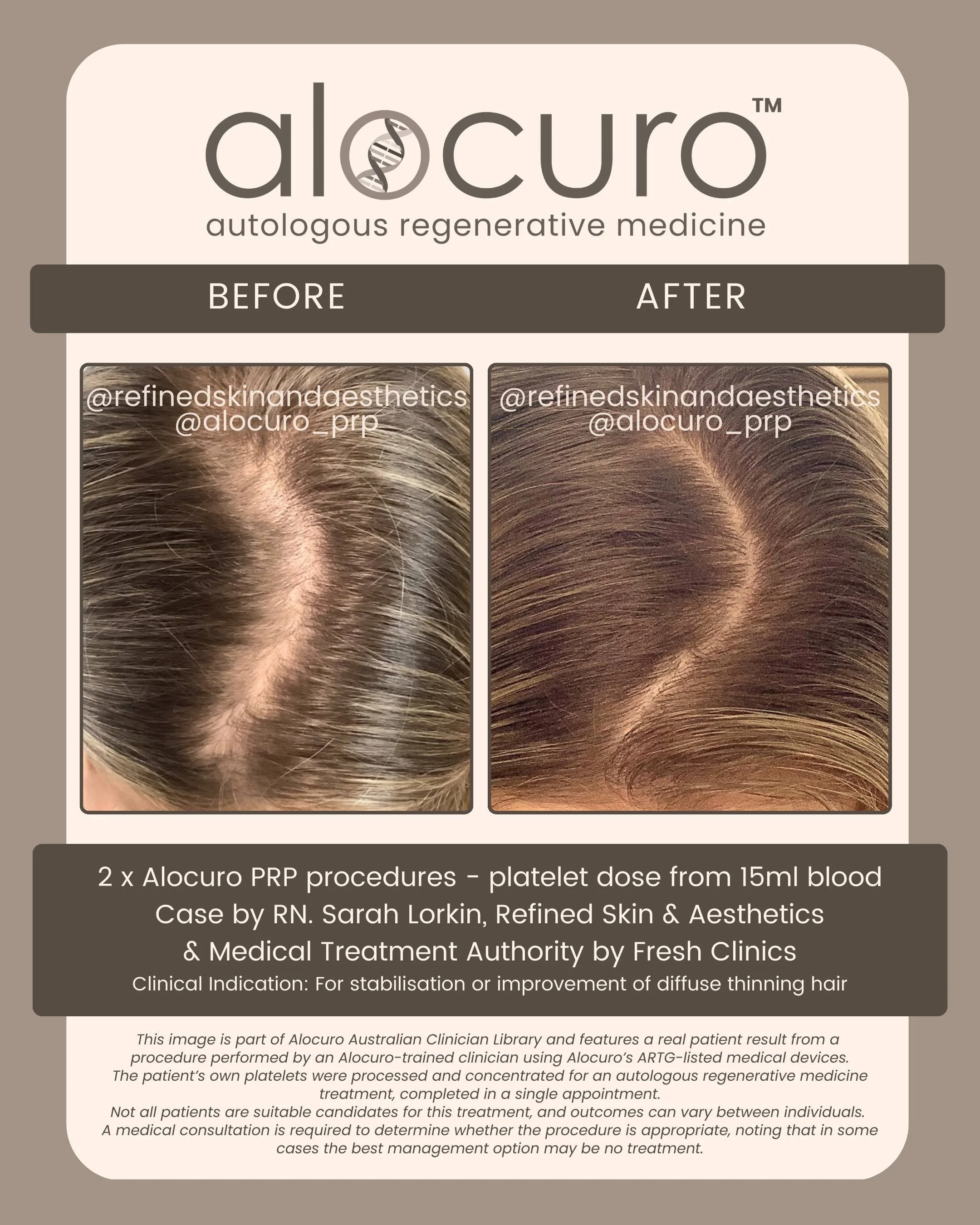 Alocuro Hair Case PRP - Before & After - 22.jpg