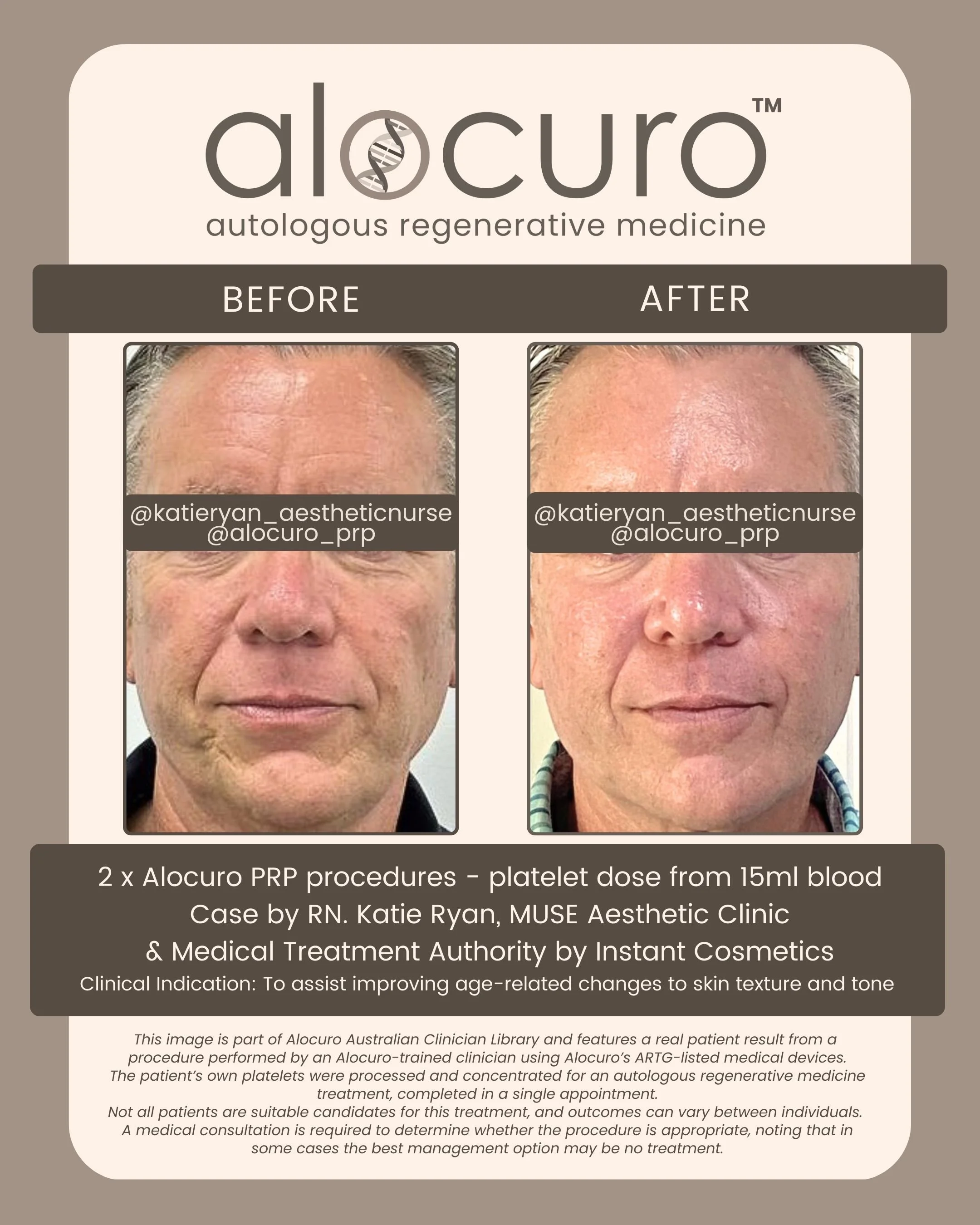 Alocuro Skin Case PRP - Before & After - 04.jpg