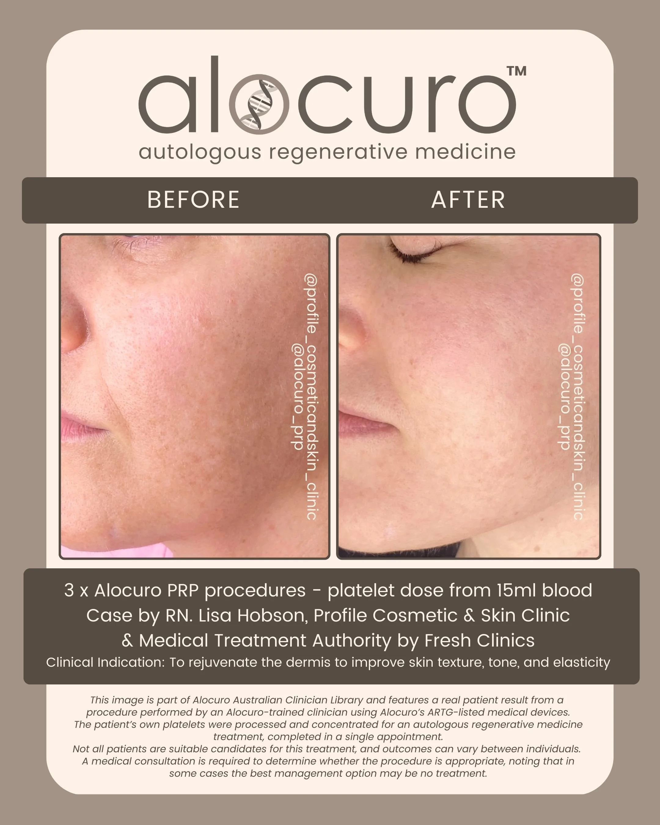 Alocuro Skin Case PRP - Before & After - 05.jpg