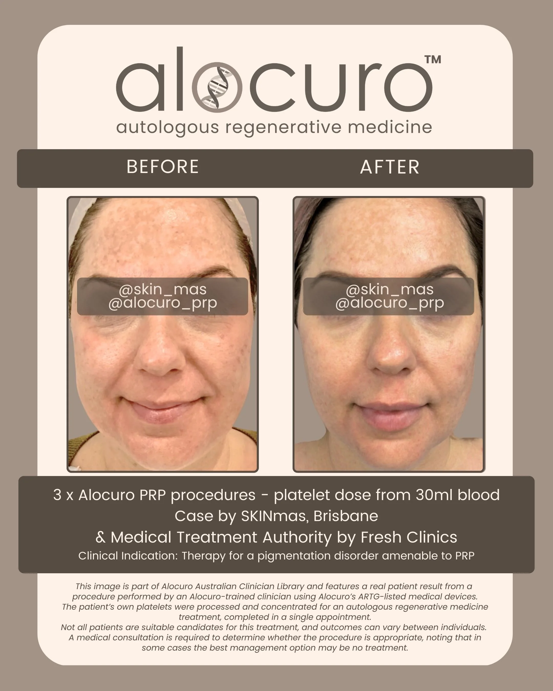 Alocuro Skin Case PRP - Before & After - 06.jpg