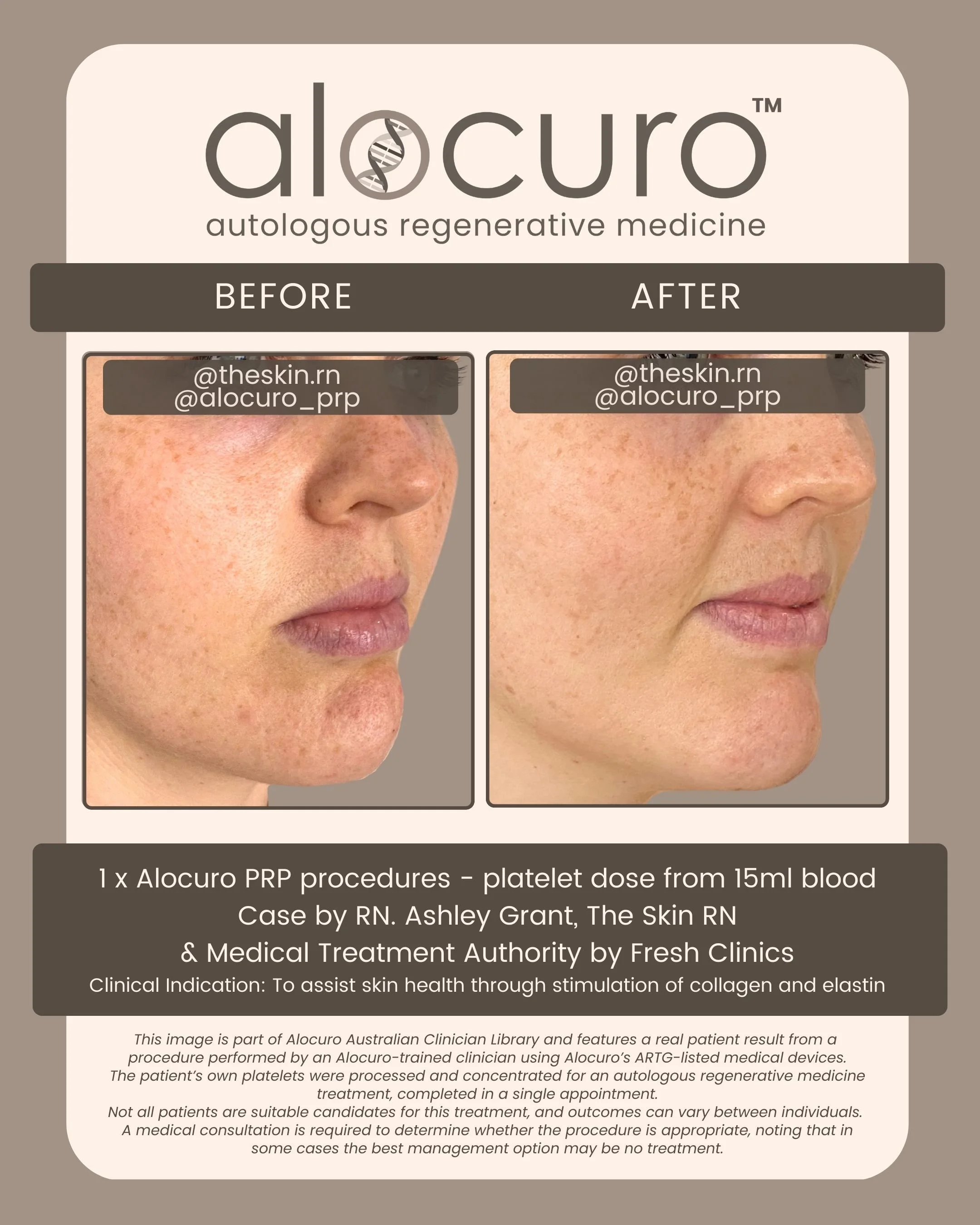 Alocuro Skin Case PRP - Before & After - 10.jpg