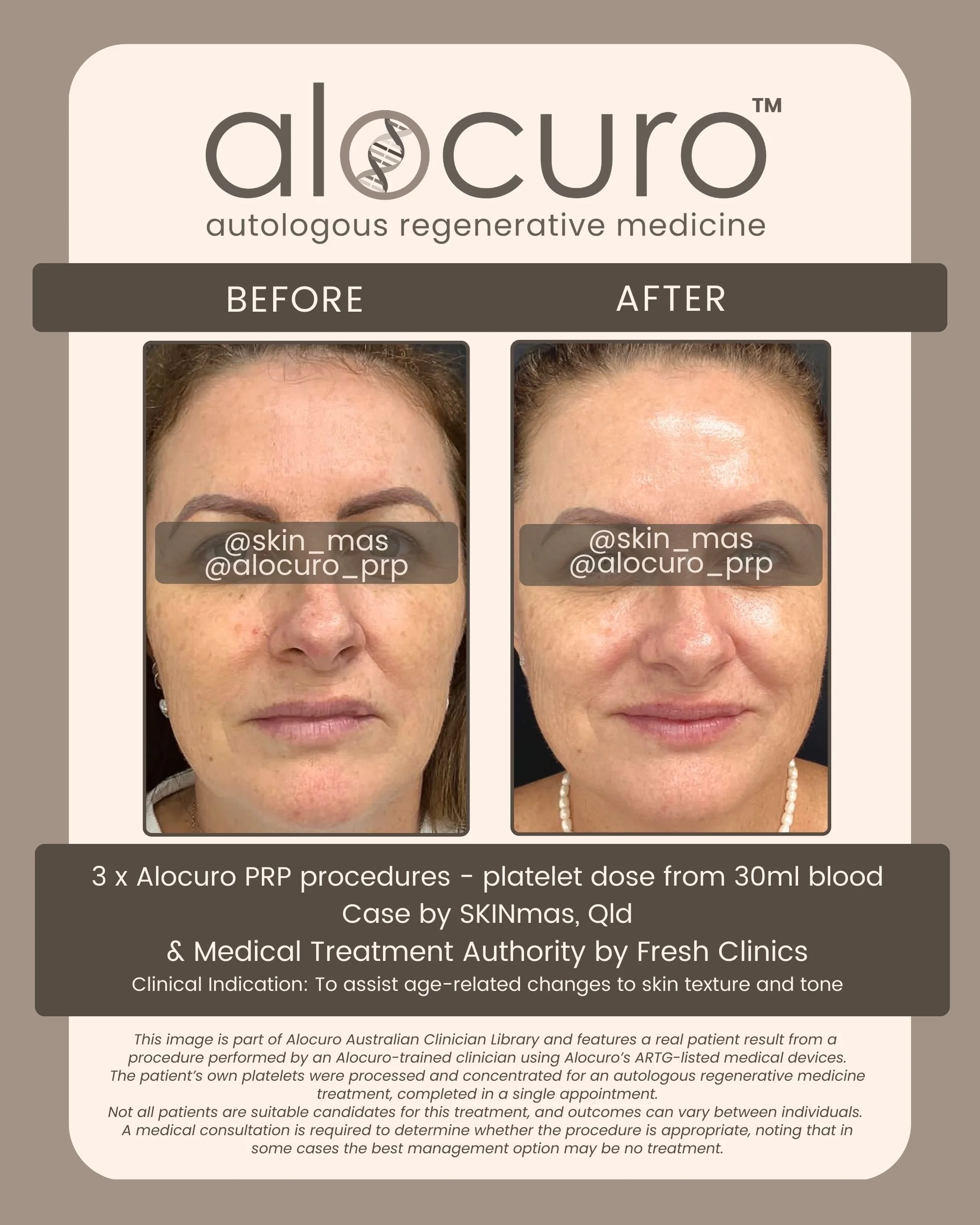 Alocuro Skin Case PRP - Before & After - 12.jpg