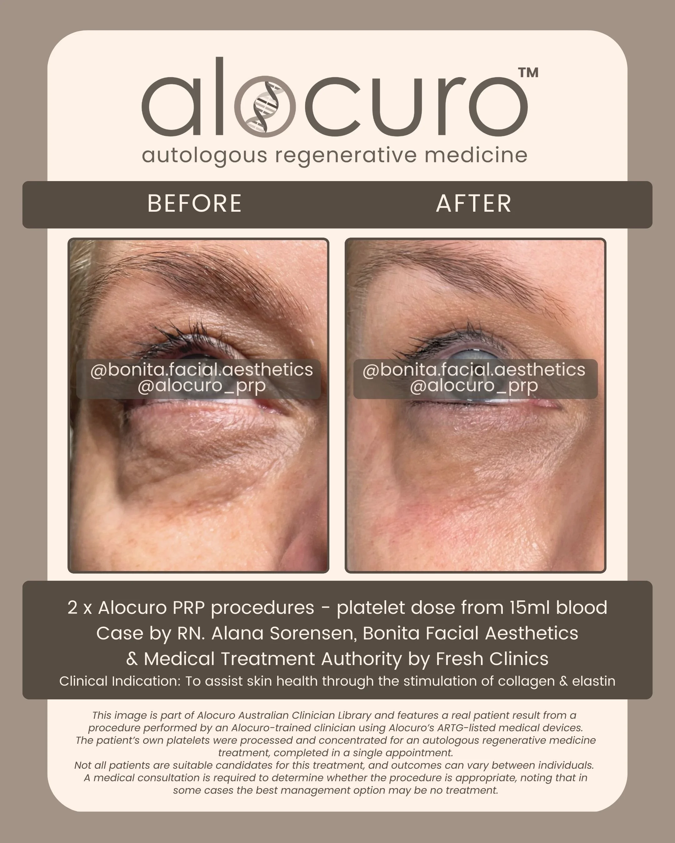 Alocuro Skin Case PRP - Before & After - 14.jpg