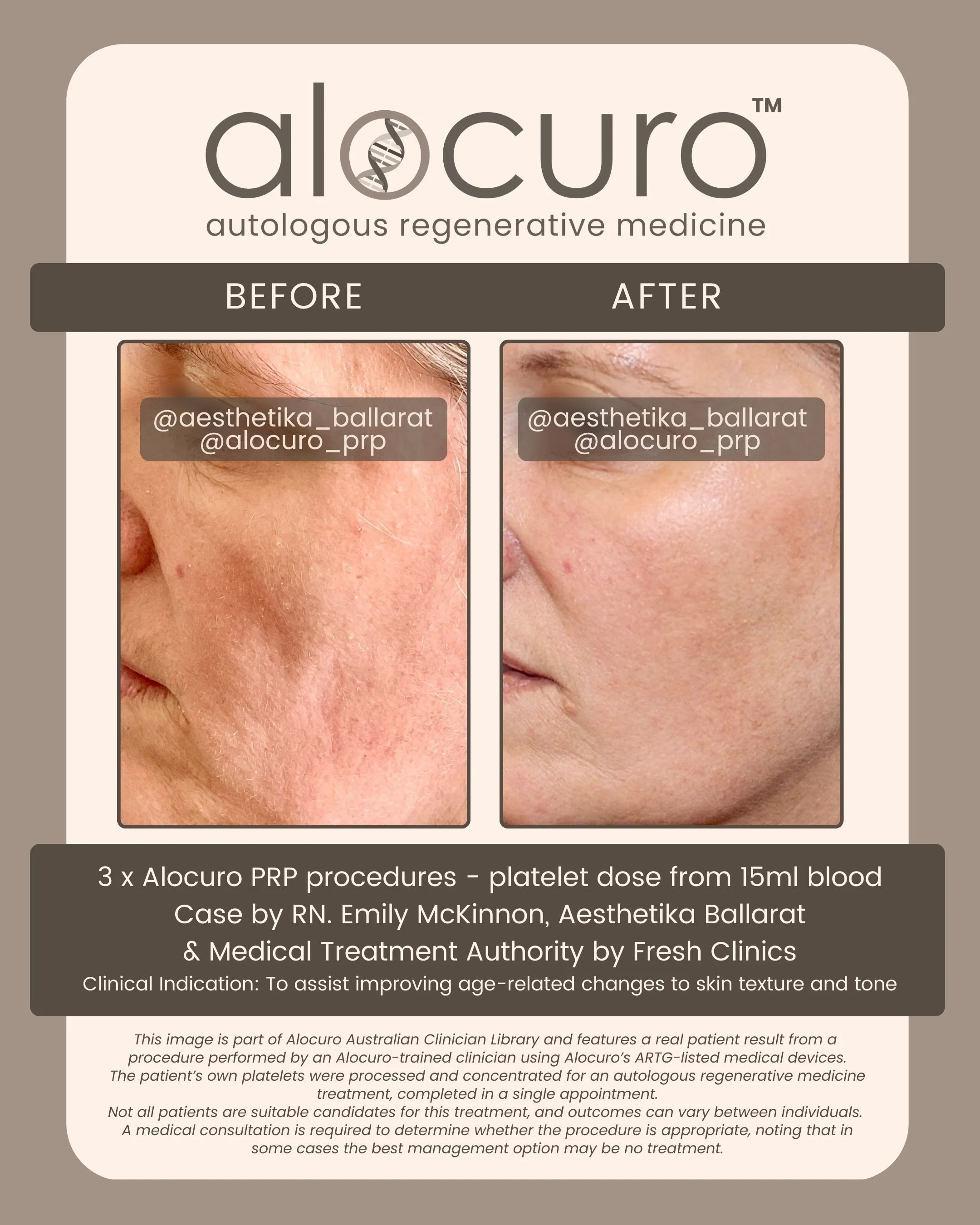 Alocuro Skin Case PRP - Before & After - 16.jpg