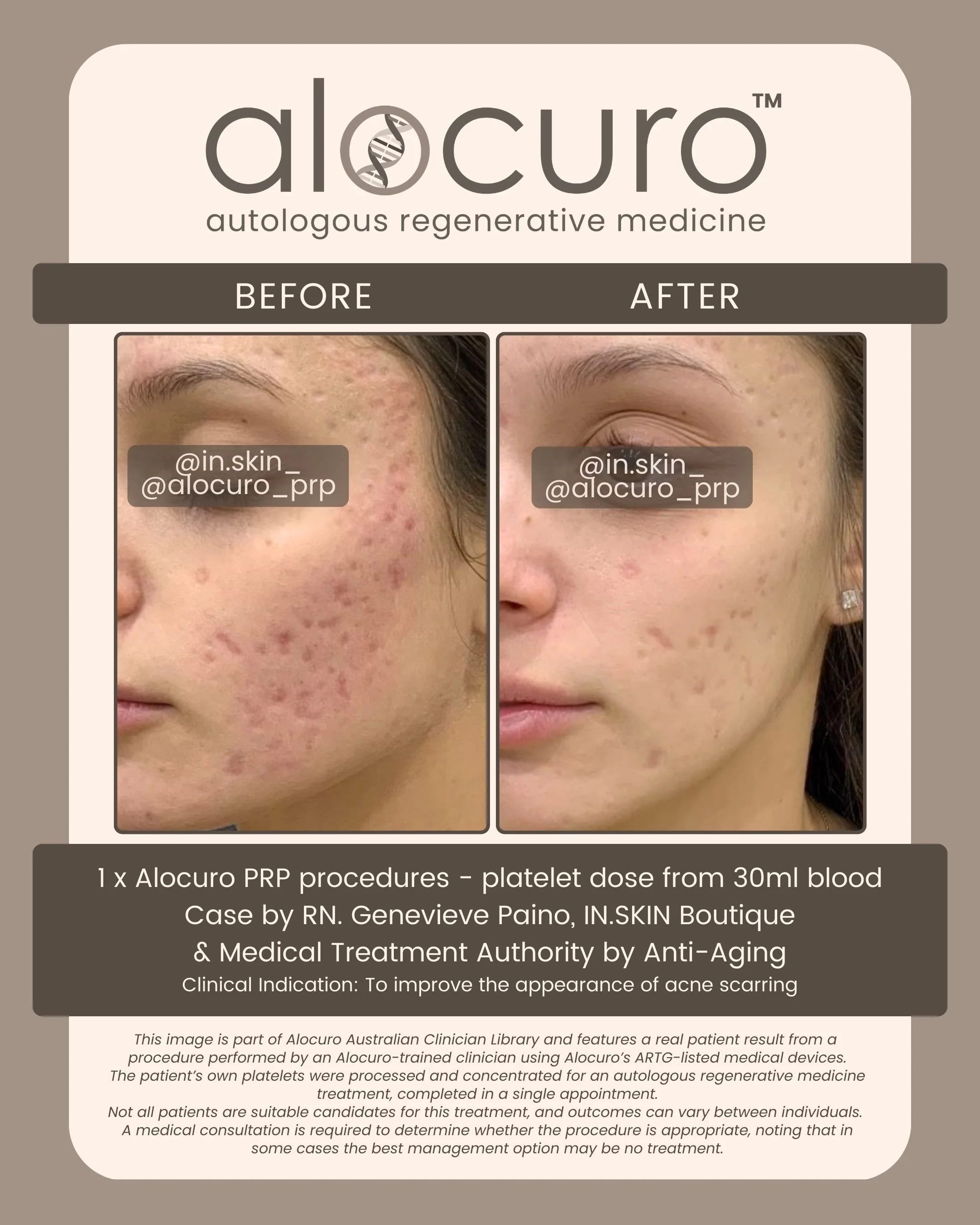 Alocuro Skin Case PRP - Before & After - 17.jpg