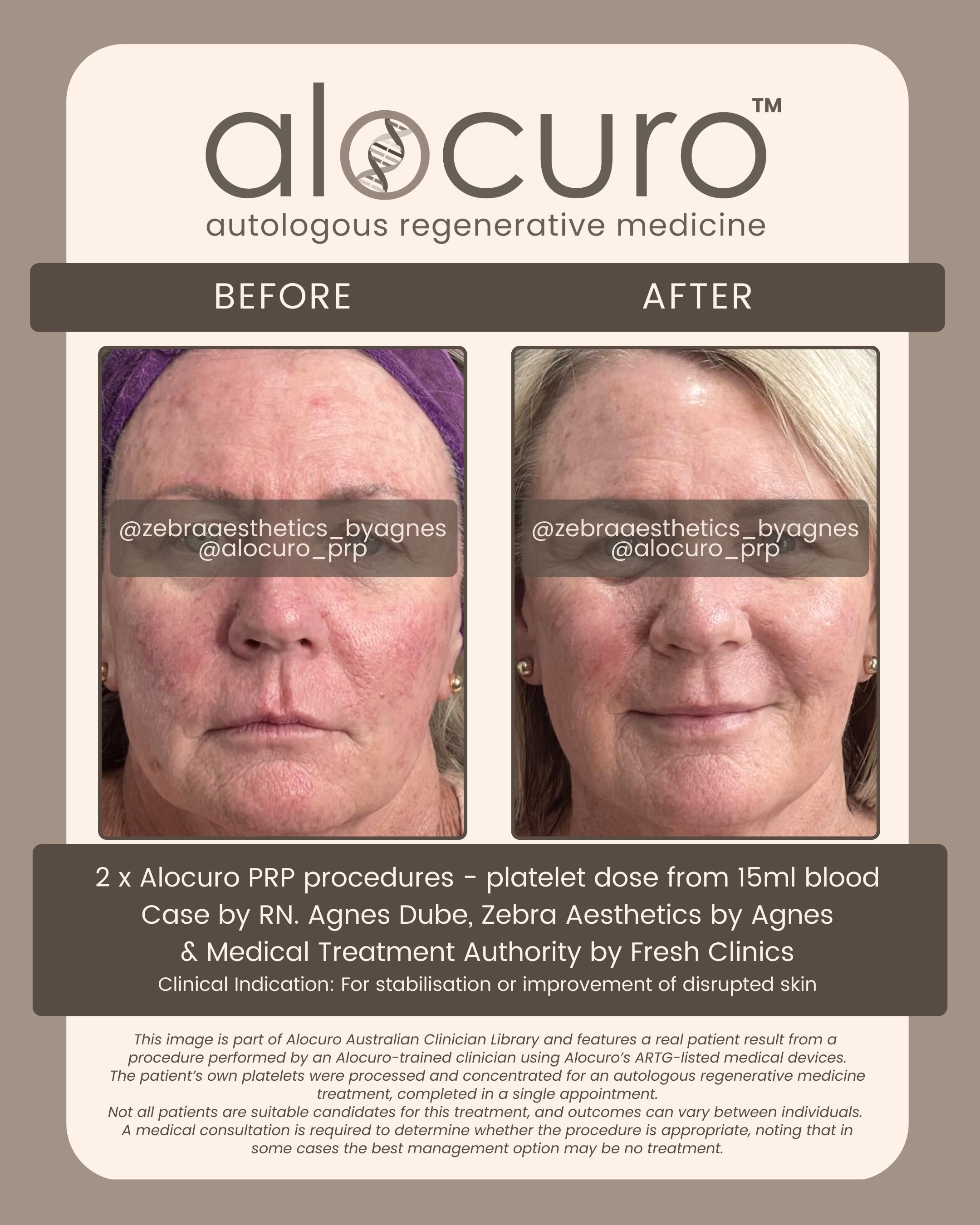 Alocuro Skin Case PRP - Before & After - 20.jpg